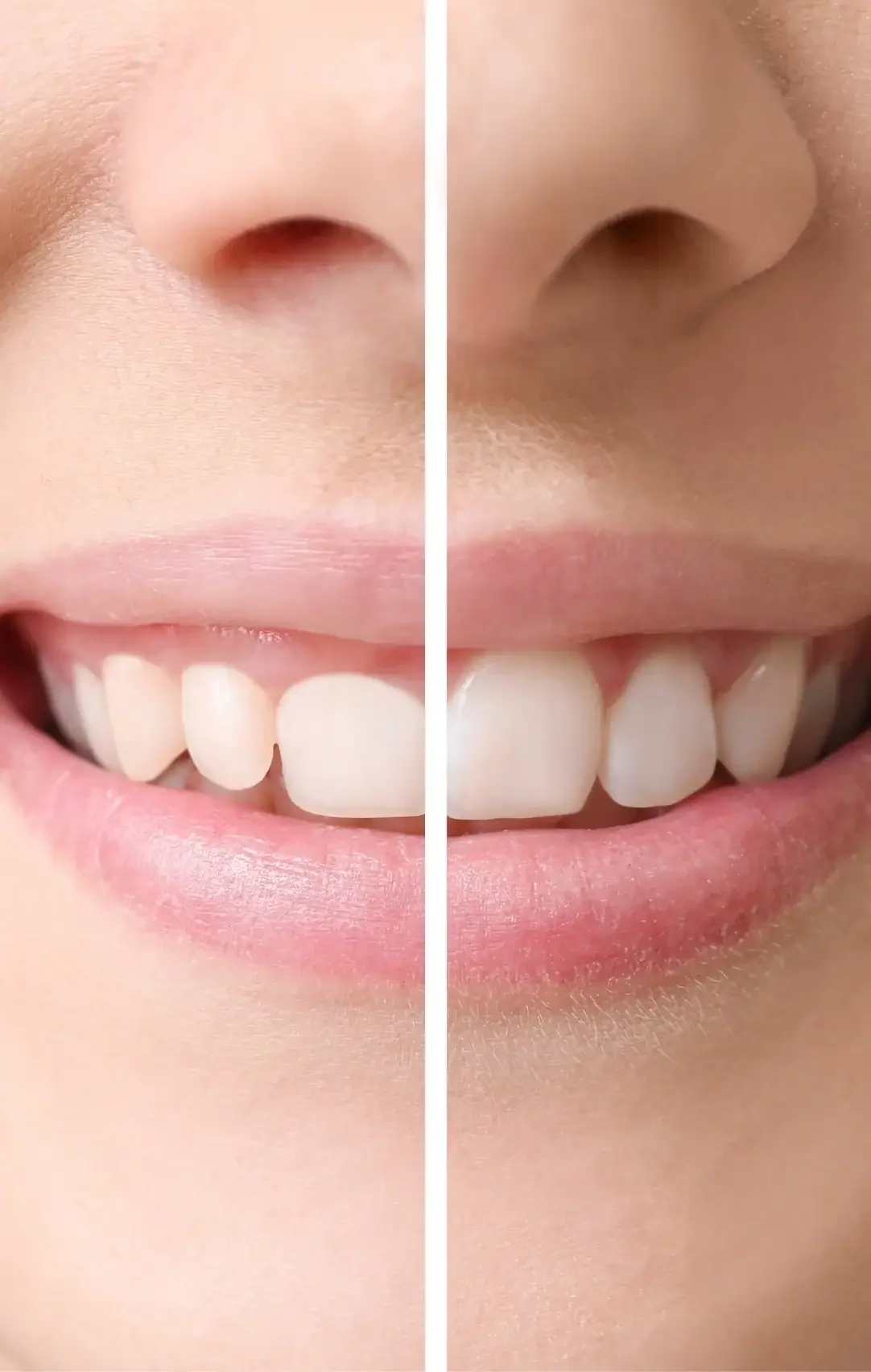 Close-up of a person's face showing a side-by-side comparison of a less perfect and a more perfect smile, with focus on teeth and mouth.