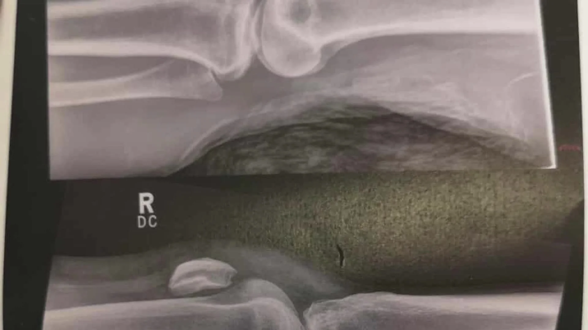 X-ray of Leanne’s knee after her injury