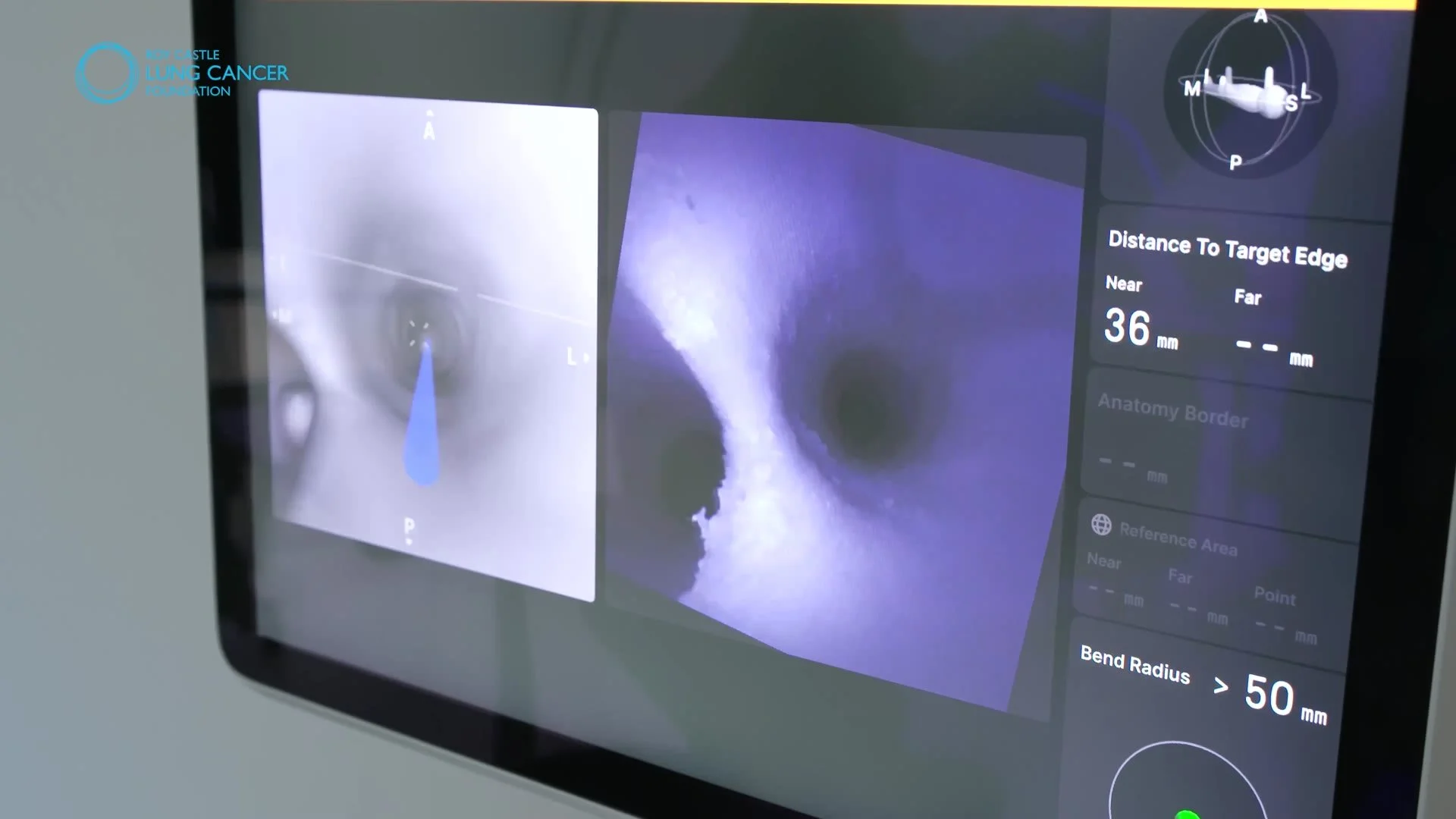 The live camera view inside the airways