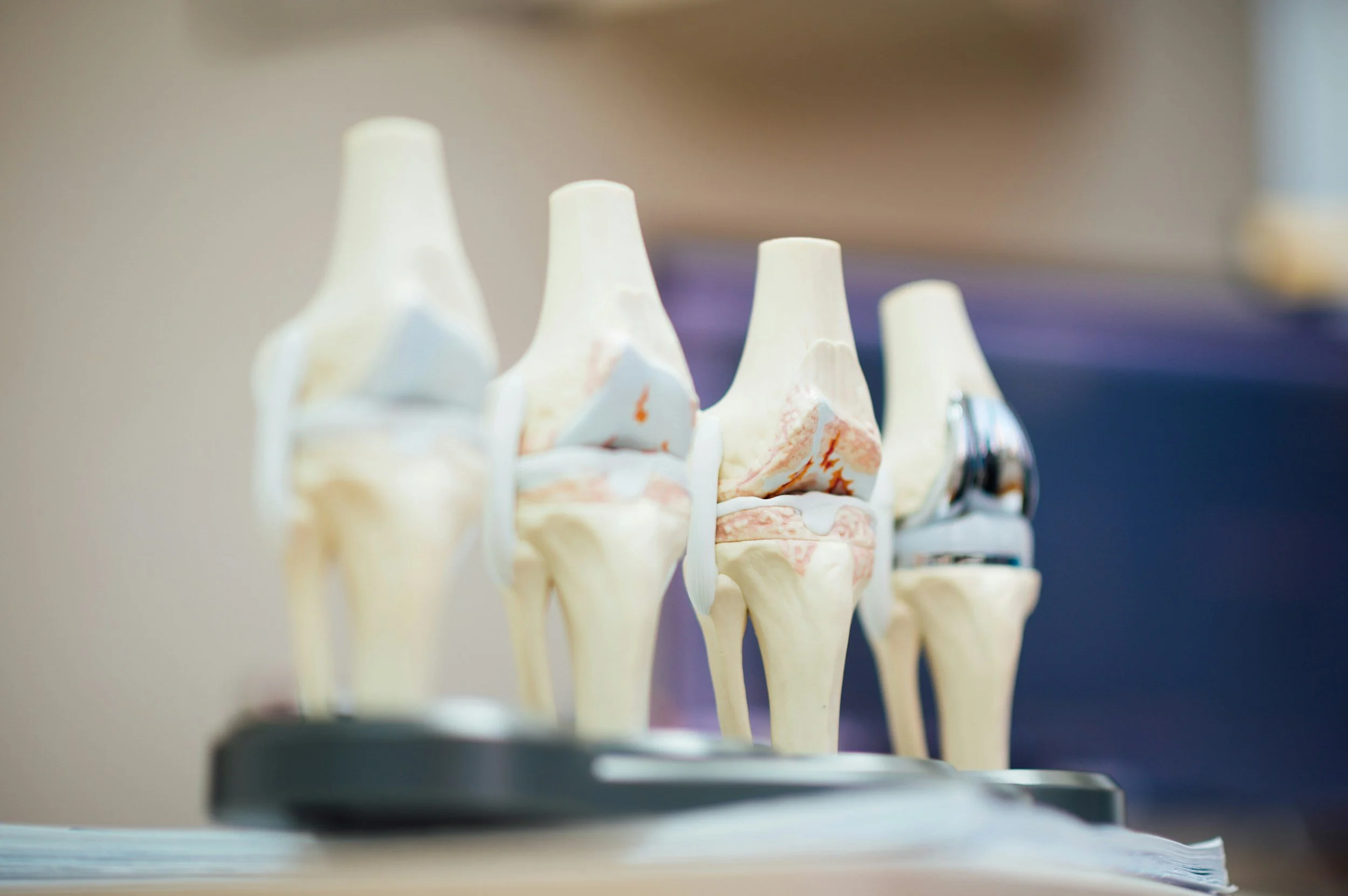 Medical model of a knee joint showing bones, cartilage, and ligaments.