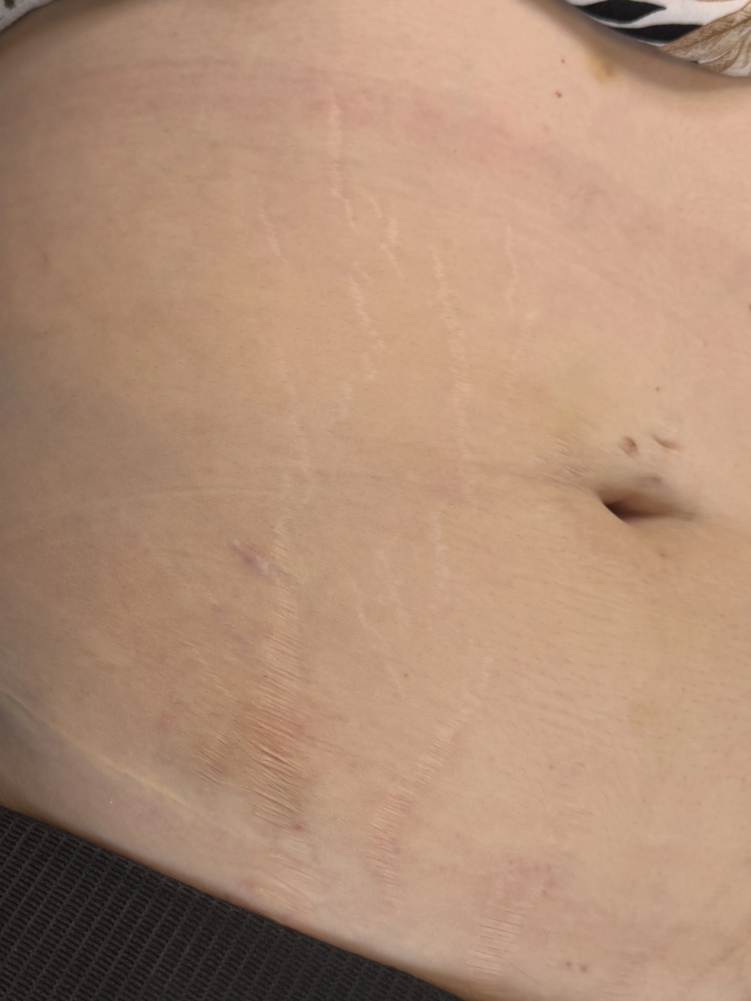 Close-up image of a person’s abdomen showing stretch marks and a navel.