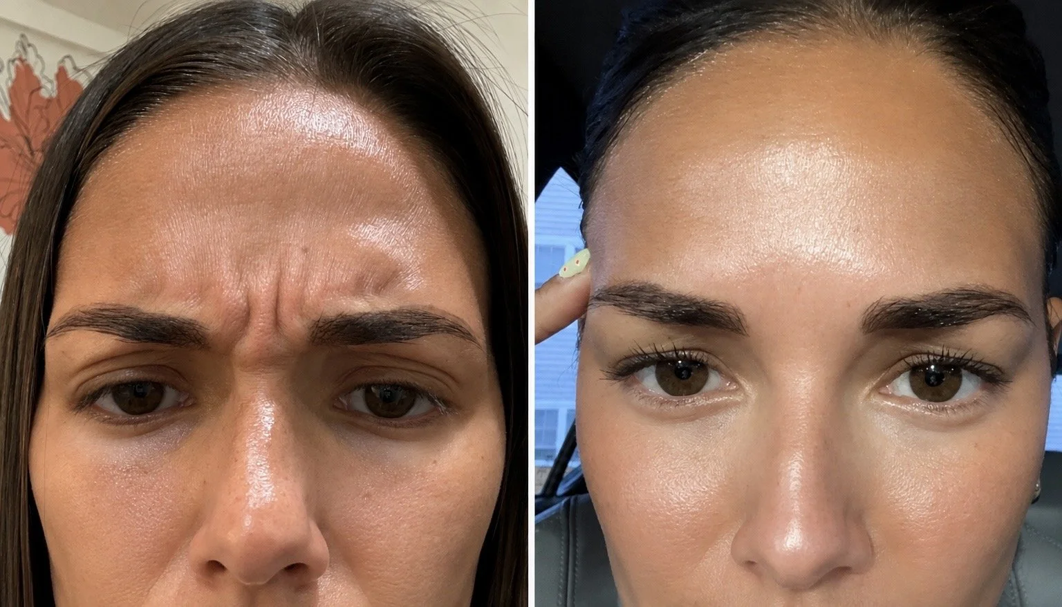 Close-up of two women's foreheads and eyes side by side; the woman on the left has frown lines on her forehead, while the woman on the right has smooth, wrinkle-free forehead.