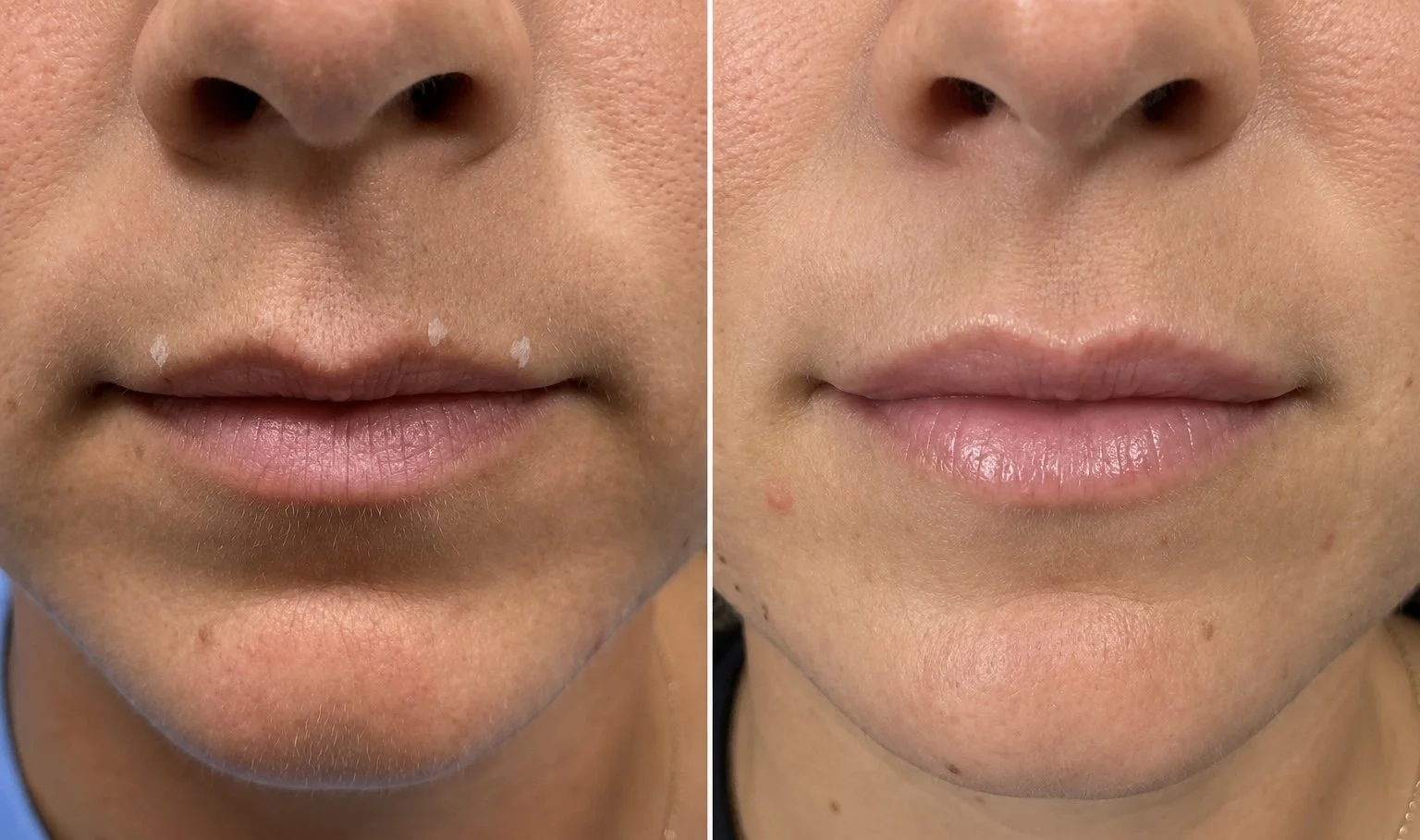Before and after lip flip treatment in Bridgeport, WV