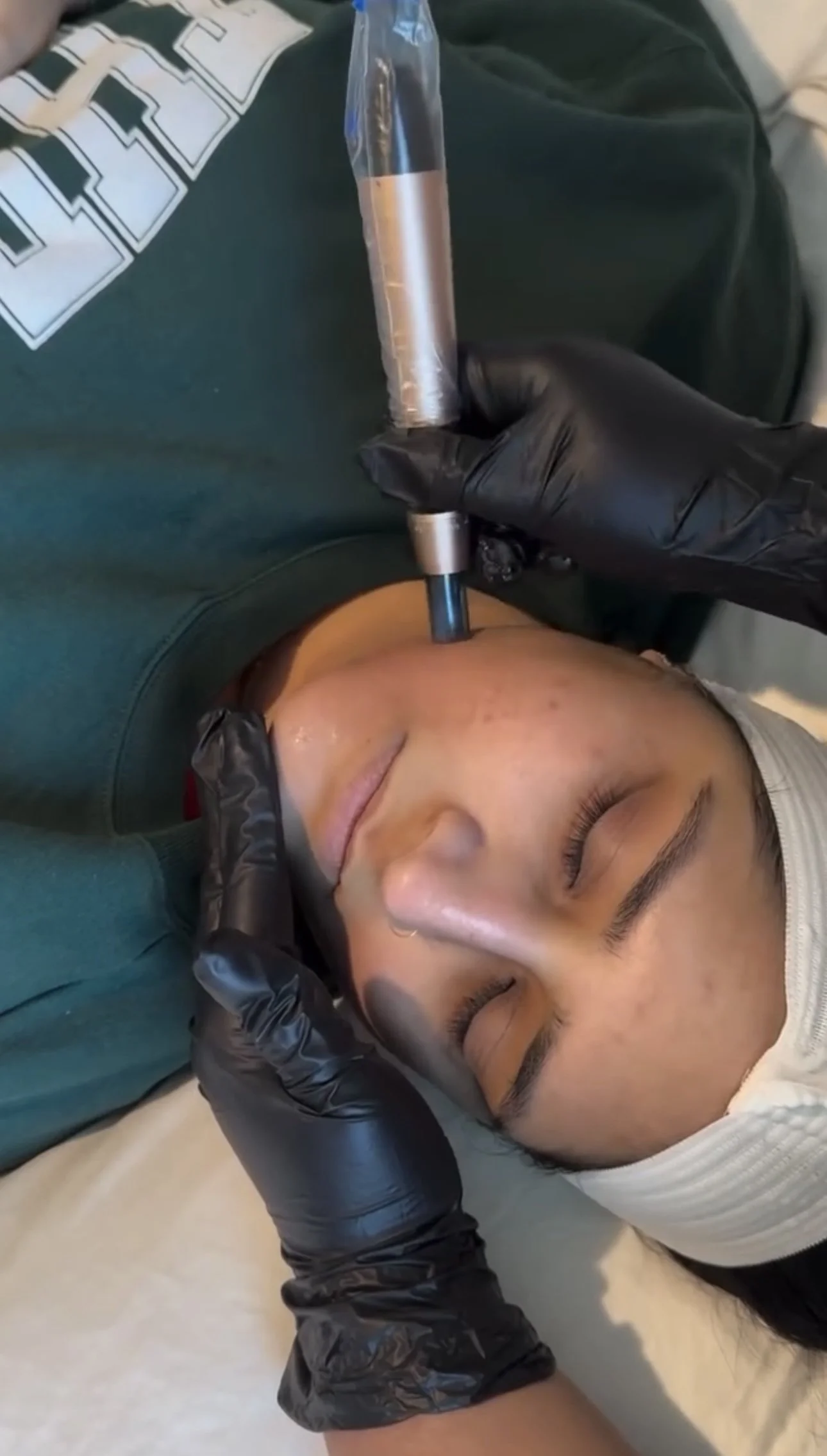 Microneedling in Morgantown WV