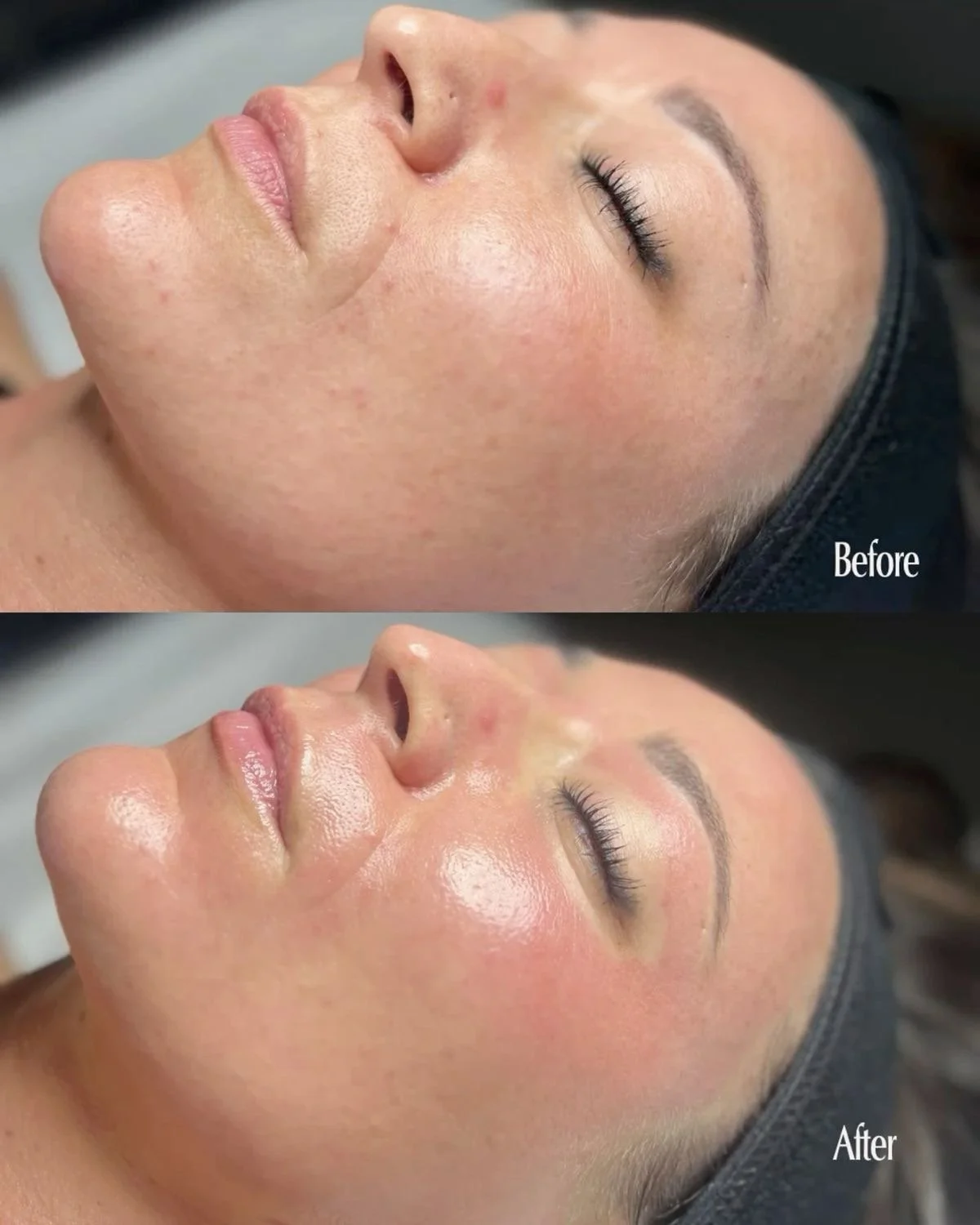 Before and After with Micorneedling in Morgantown WV