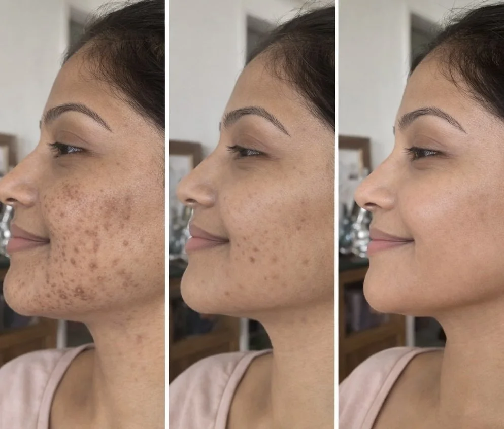 Pigmentation &amp; Melasma – Causes, Treatments &amp; Prevention