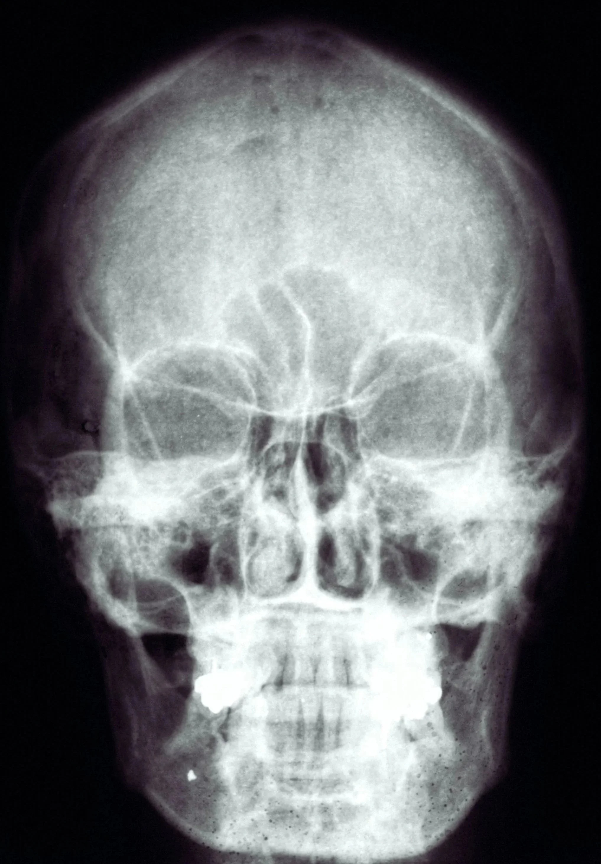 An X-ray image of a human skull.
