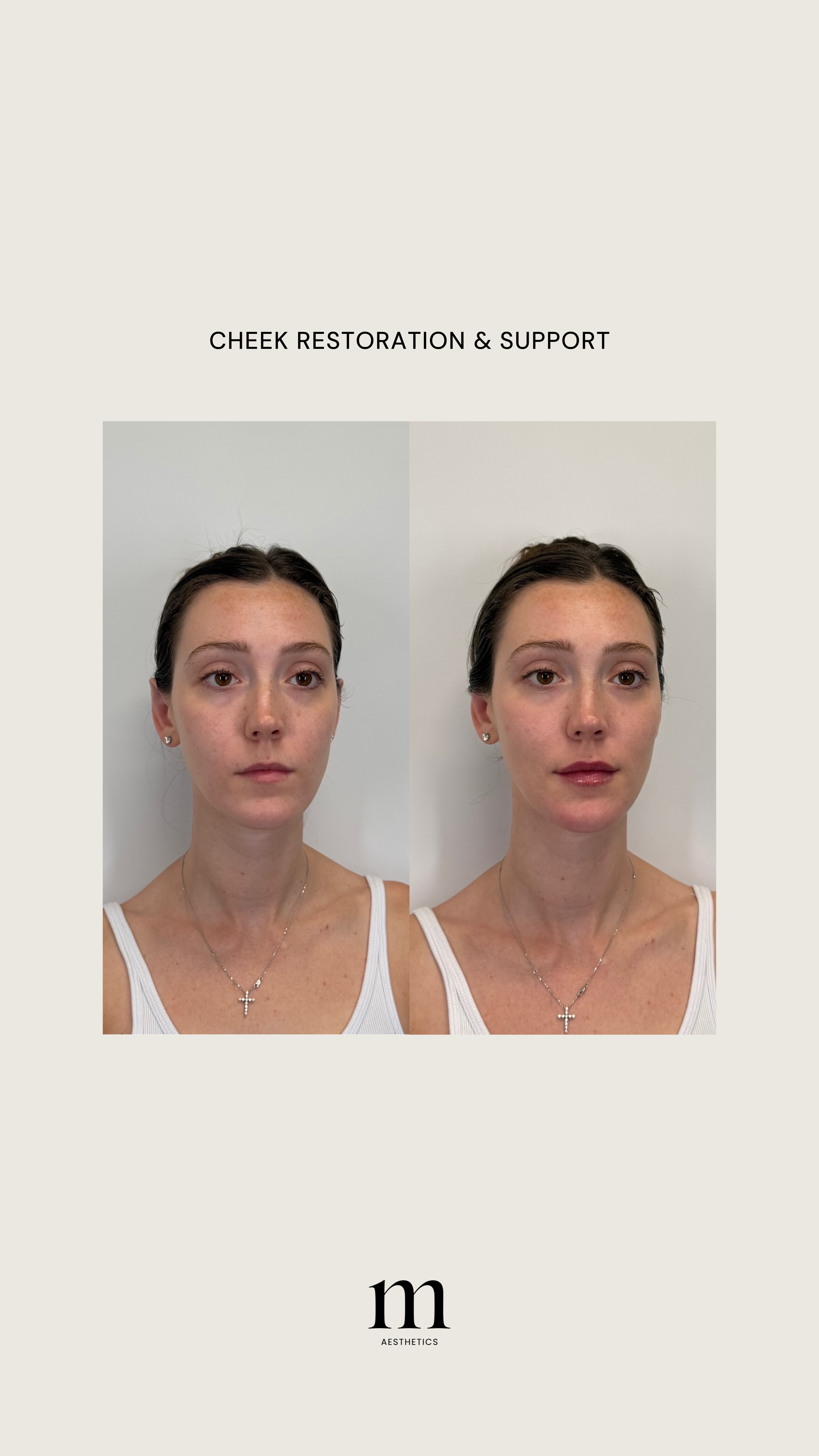 Side-by-side photos of a woman before and after cheek restoration and support, showing facial improvements, with the words 'CHEEK RESTORATION & SUPPORT' above and a logo with the letter 'm' and 'AESTHICS' below.