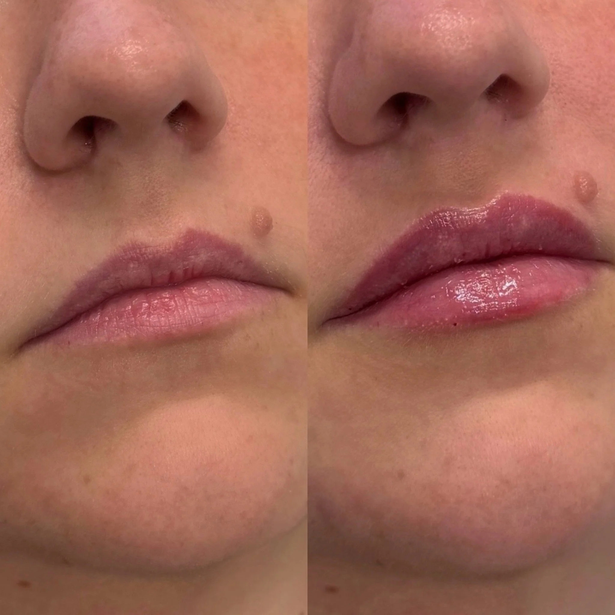 Dermal Fillers