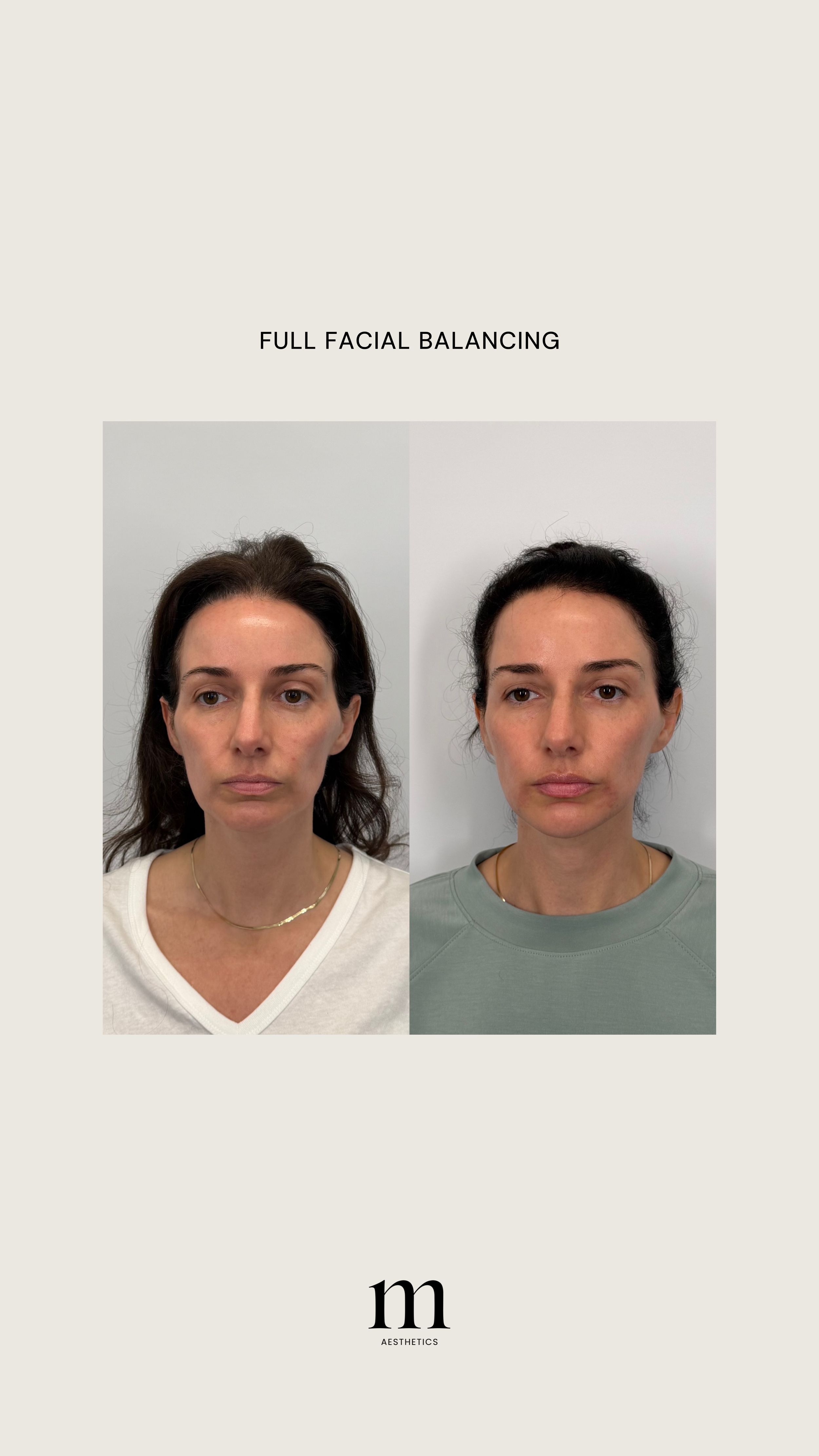Before and after photos of a woman showing facial changes, labeled 'Full Facial Balancing', with a logo 'm Aesthetics' at the bottom.