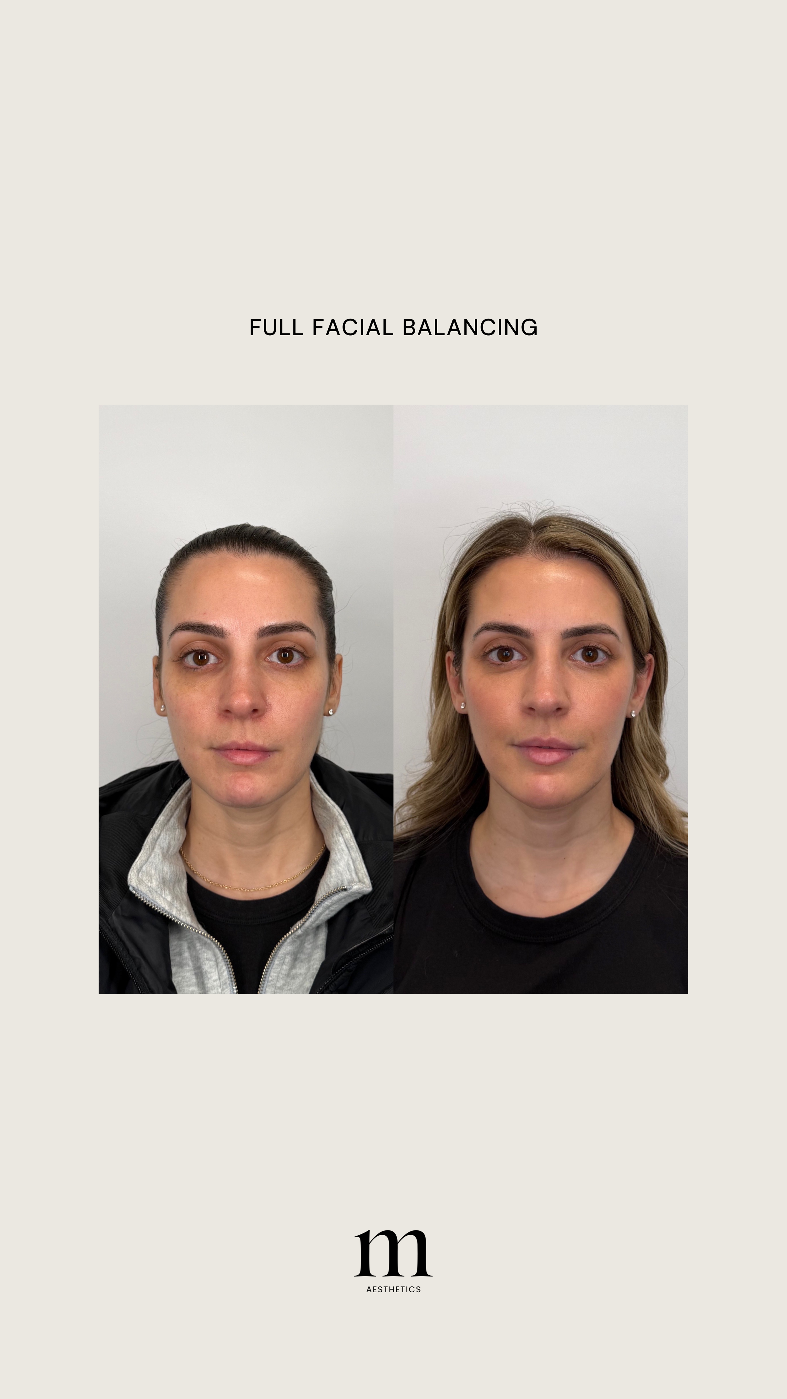 Before and after photos showing a woman's face with a focus on facial appearance, labeled 'Full Facial Balancing' and 'm Aesthetics' at the bottom.
