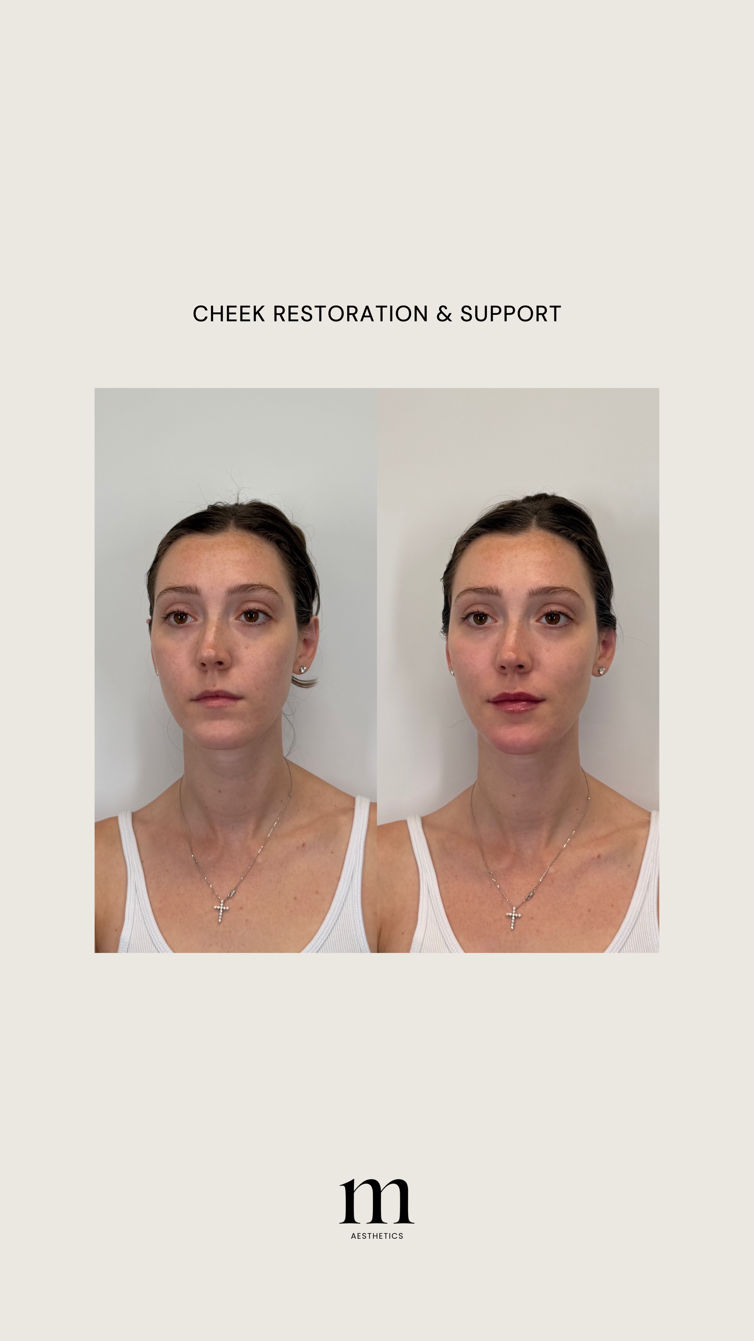 Before and after images of a woman showing the results of cheek restoration and support, with text "CHEEK RESTORATION & SUPPORT" above the images and a logo "m AESTHETICS" below.