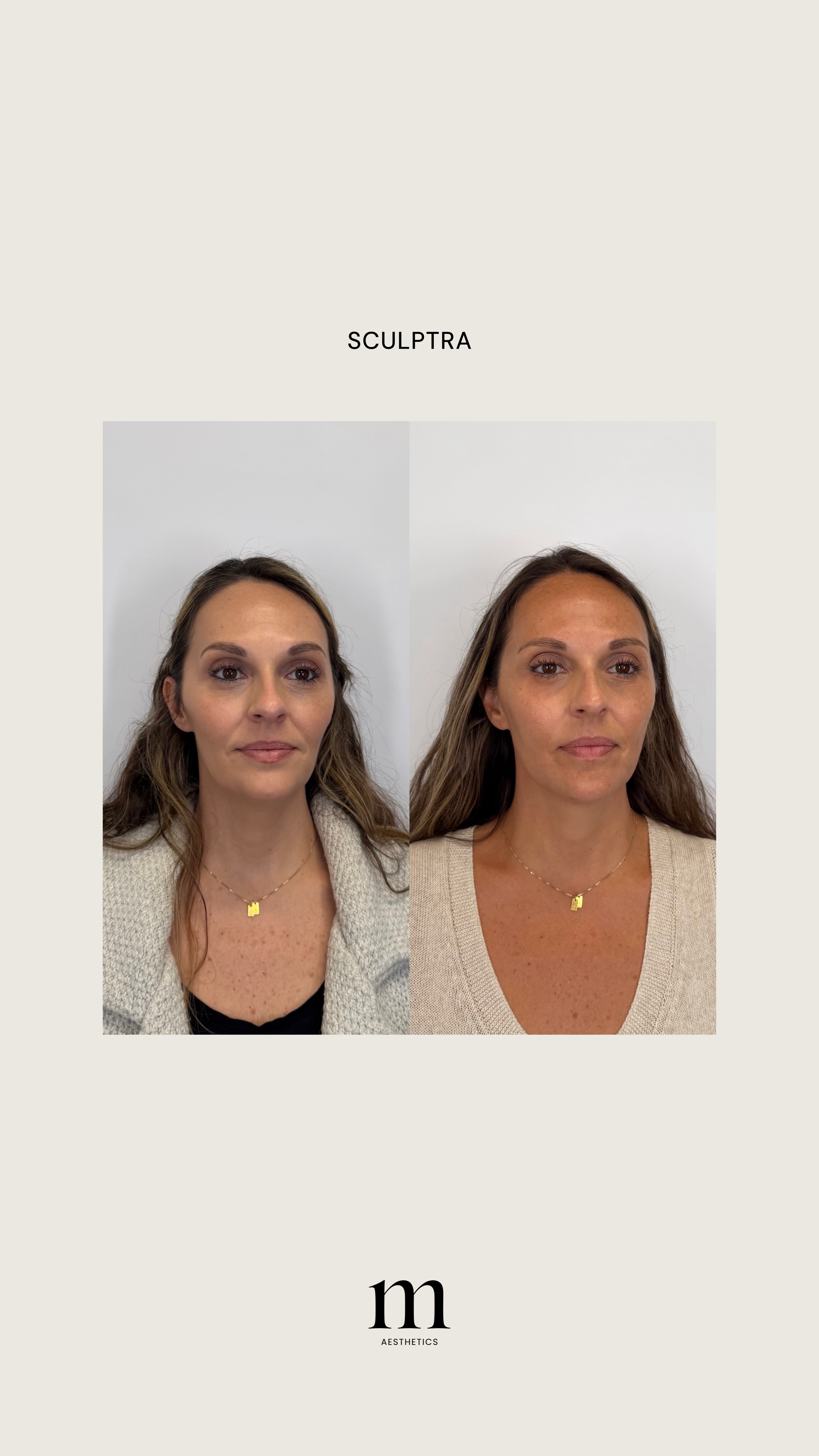 Before and after images of a woman showing facial changes, labeled 'SCULPTRA' and 'AESTHETICS' for cosmetic treatment results.