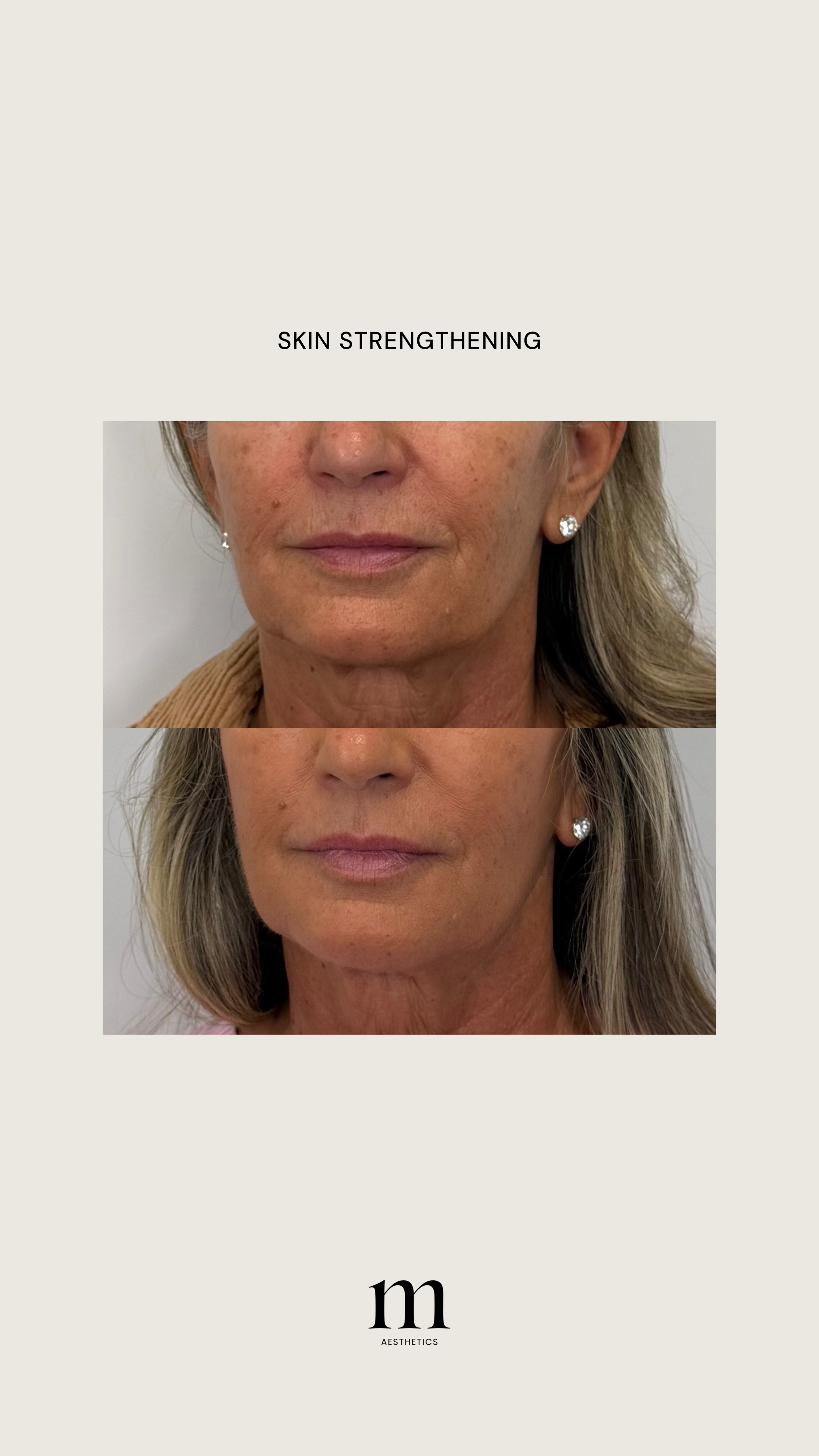 Before and after images of a woman's face showing skin rejuvenation results, with the words 'Skin Strengthening' in the center and 'm Aesthetics' logo at the bottom.