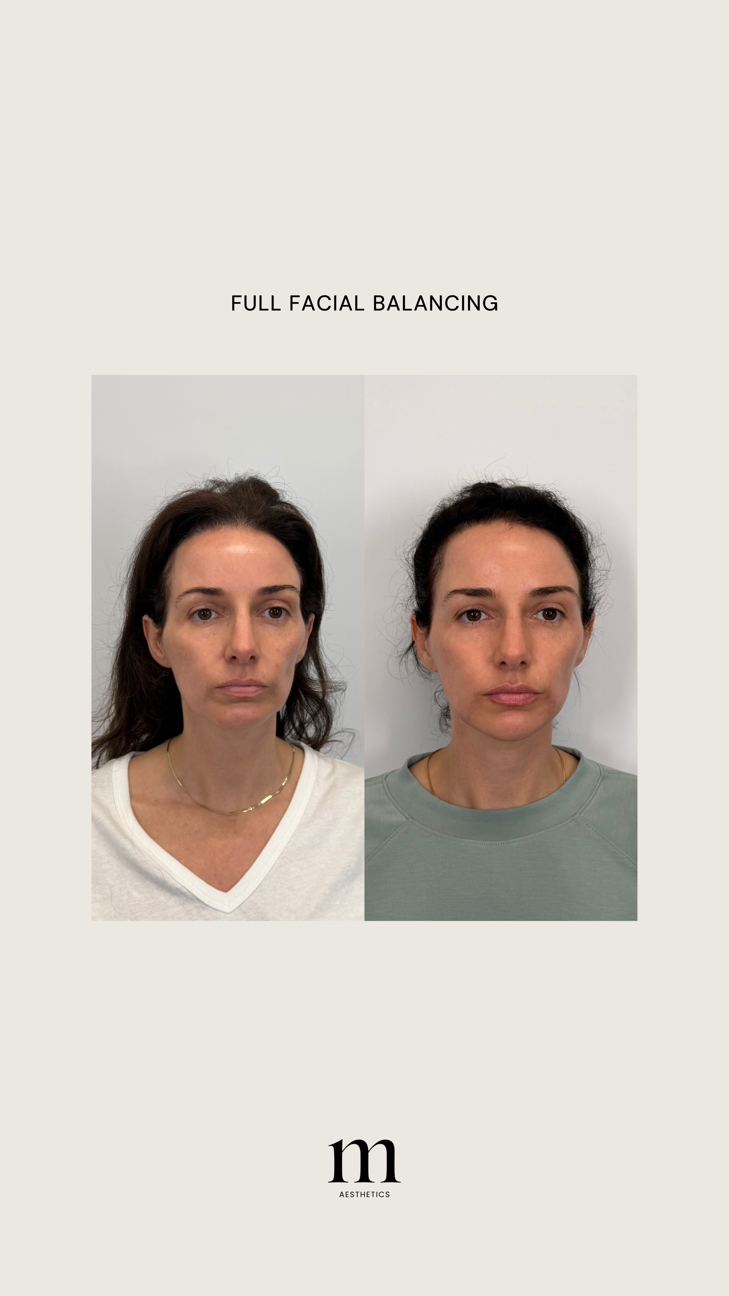 Side-by-side photos of a woman before and after facial balancing treatment, with the words 'FULL FACIAL BALANCING' and 'm AESTHETICS'.