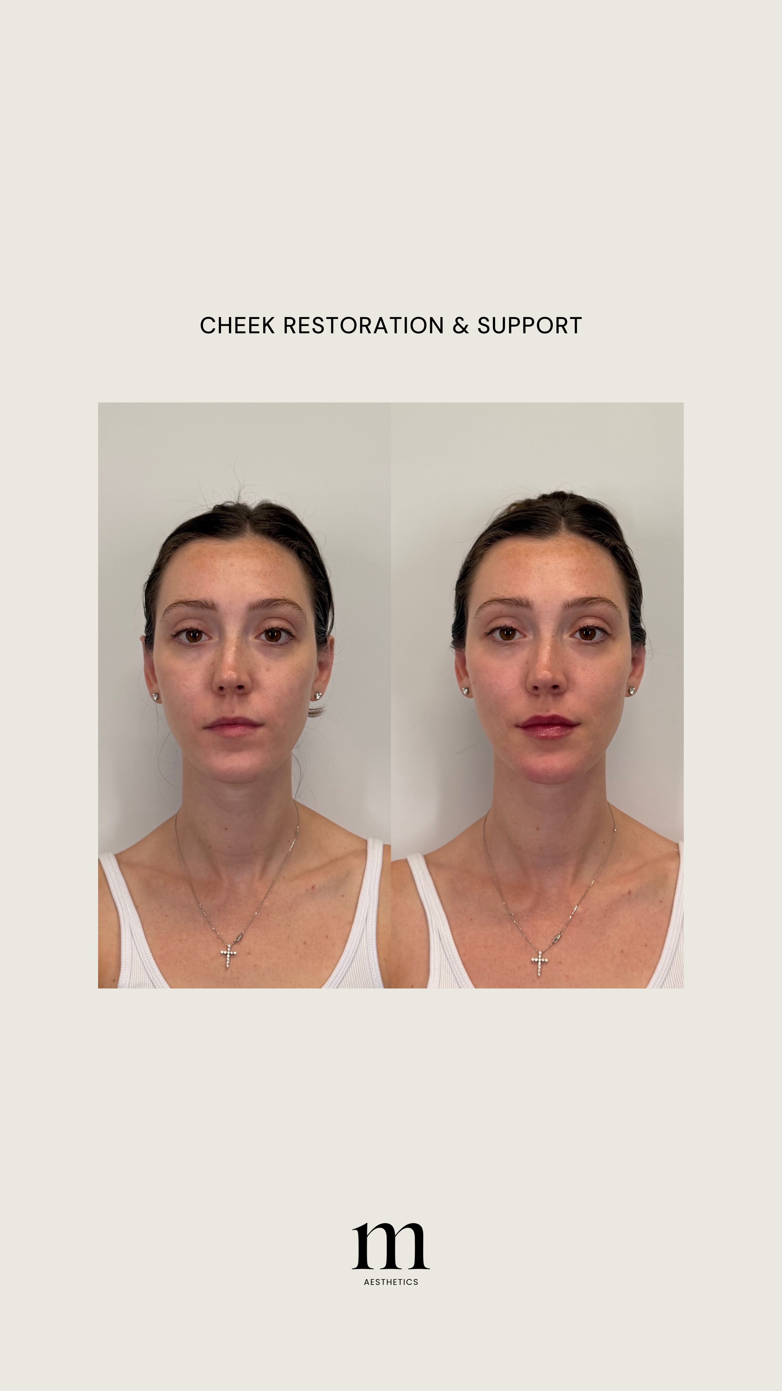 Before and after images of a woman showing cheek restoration and support, with text 'Cheek Restoration & Support' and a logo with the letter 'm' and the word 'Aesthetics'.