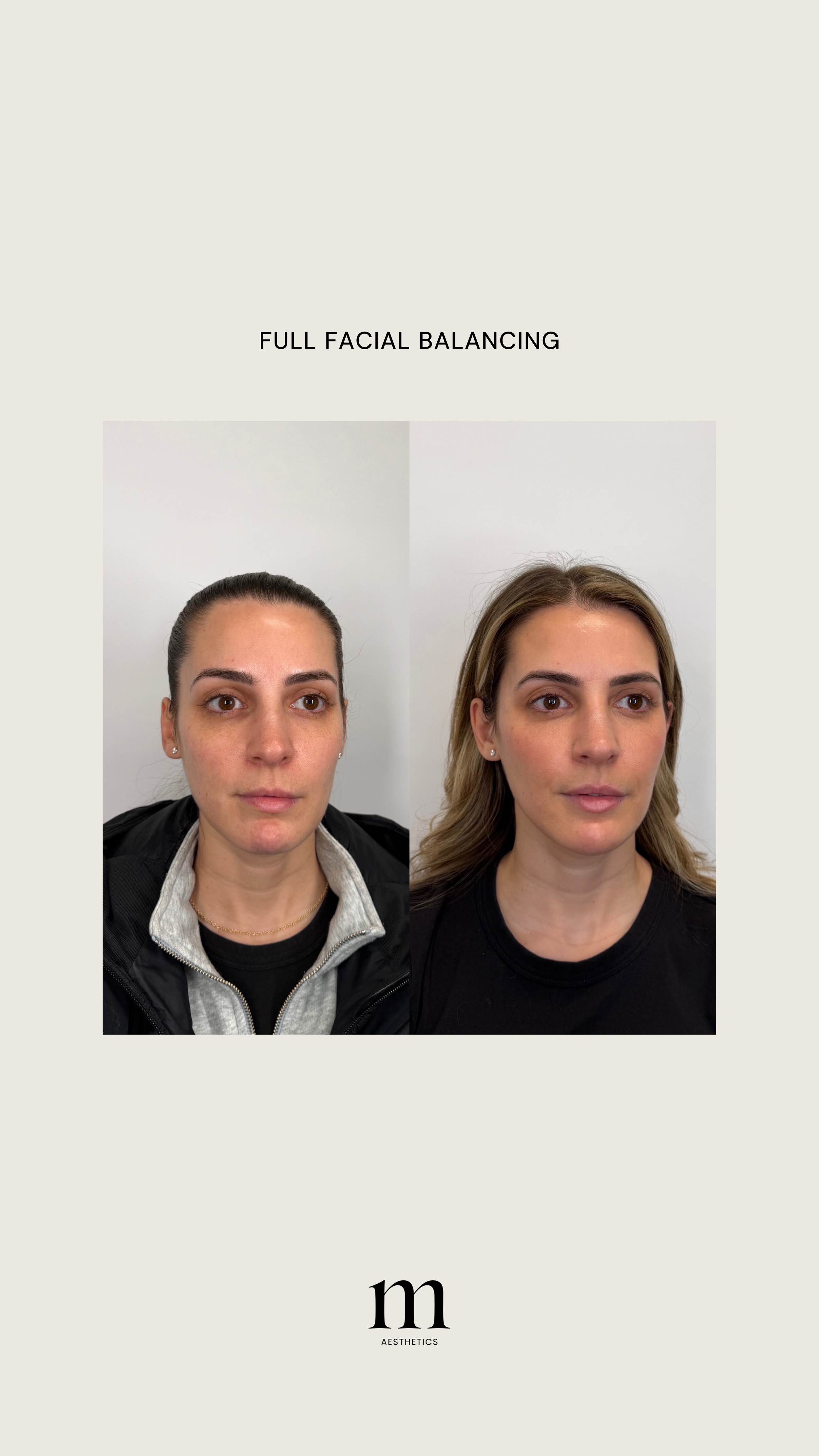 Side-by-side before and after photos of a woman showing facial transformation, labeled 'Full Facial Balancing,' with the logo 'm Aesthetics' below.