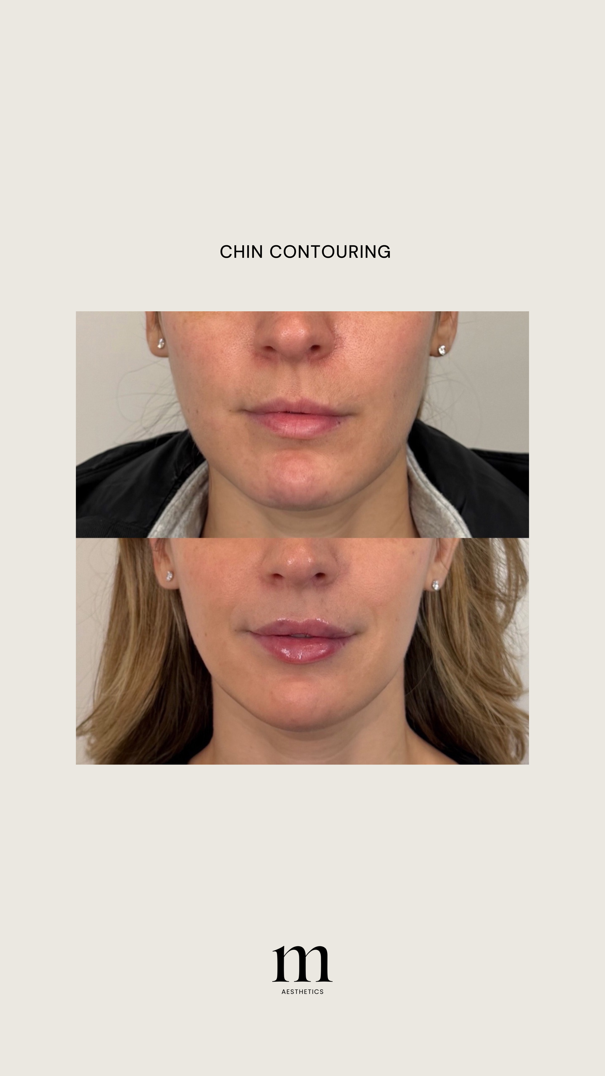 Before and after images of a woman showcasing chin contouring results, with text 'Chin Contouring' and the M Aesthetics logo.