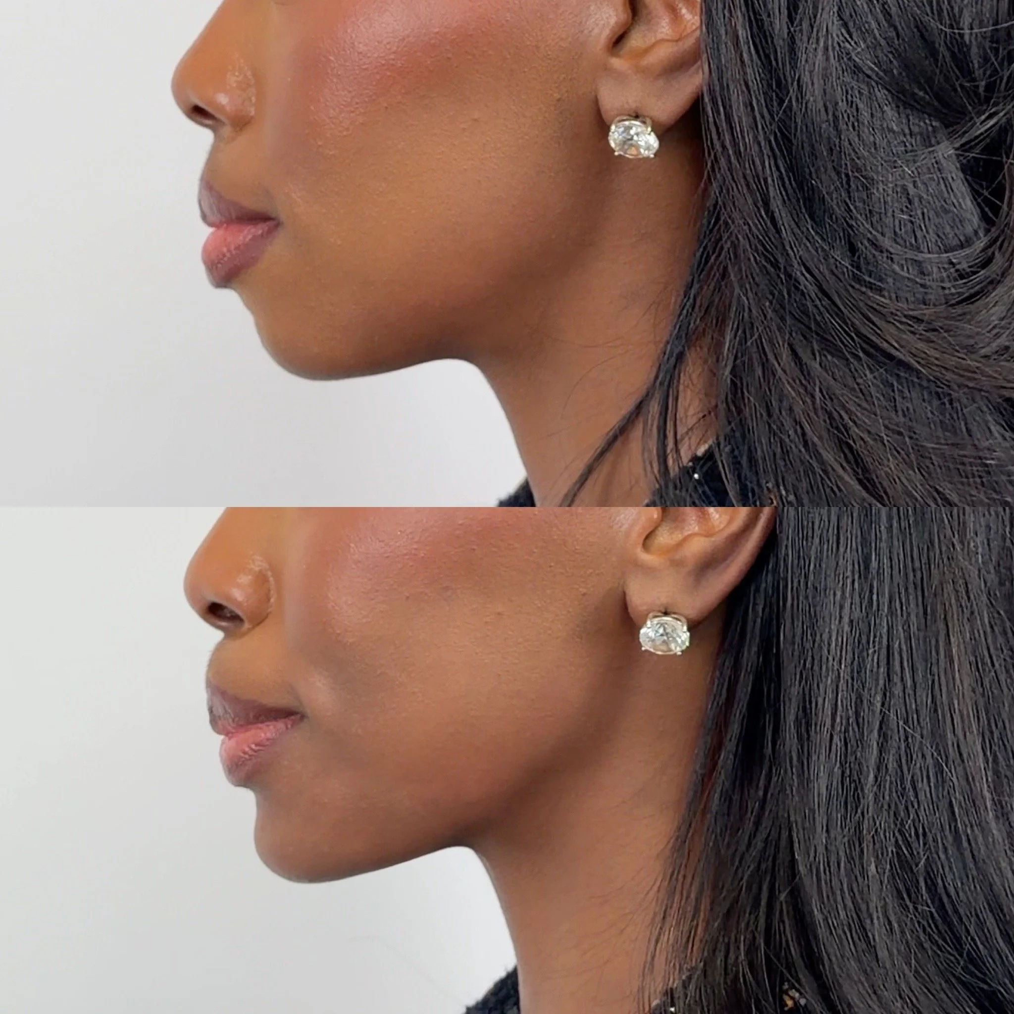 Dermal Fillers in Malvern, PA