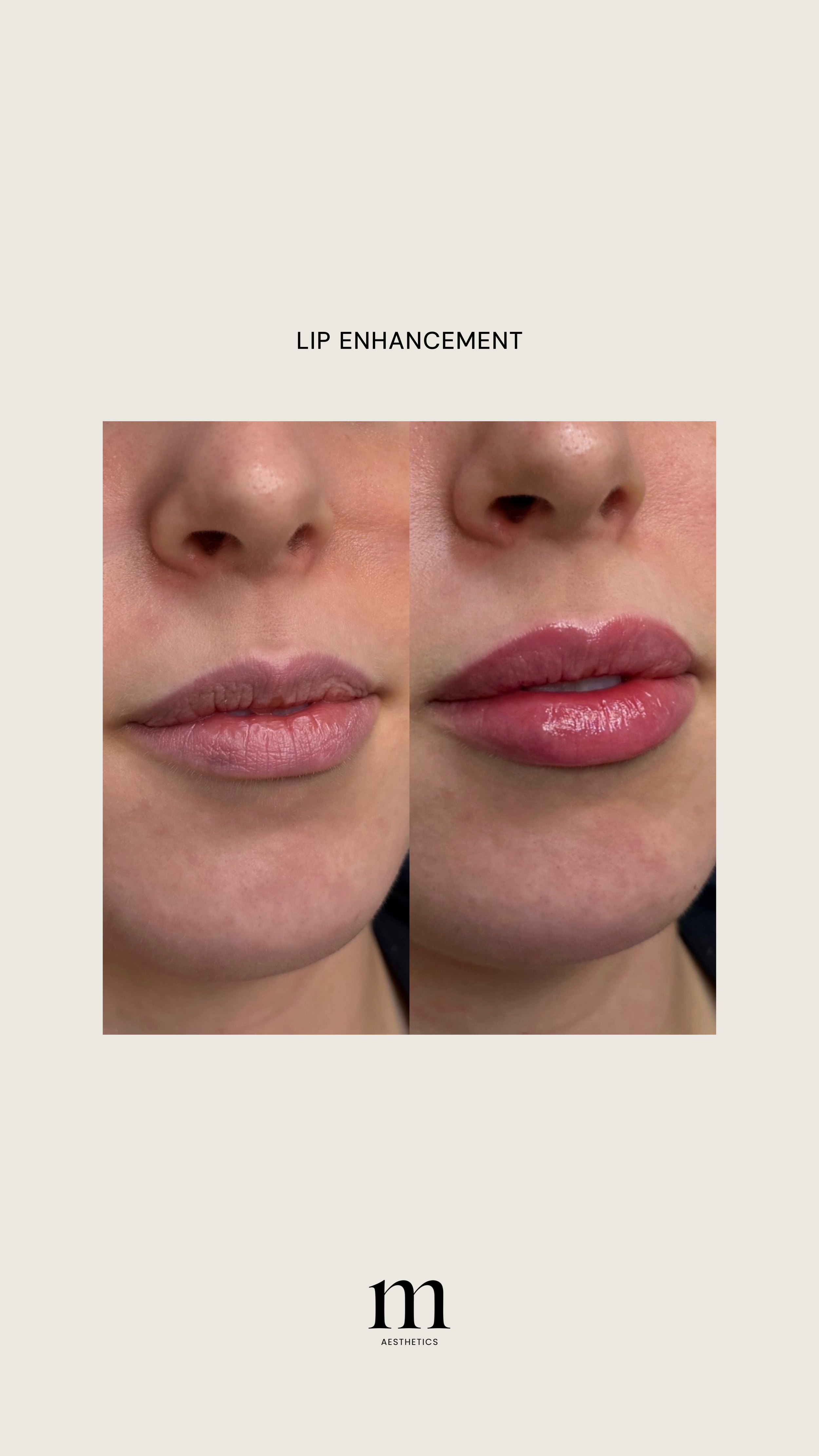 Close-up photo showing a side-by-side comparison of lips before and after lip enhancement procedure, with the caption 'Lip Enhancement' and the letter 'm' with the word 'Aesthetics' below.