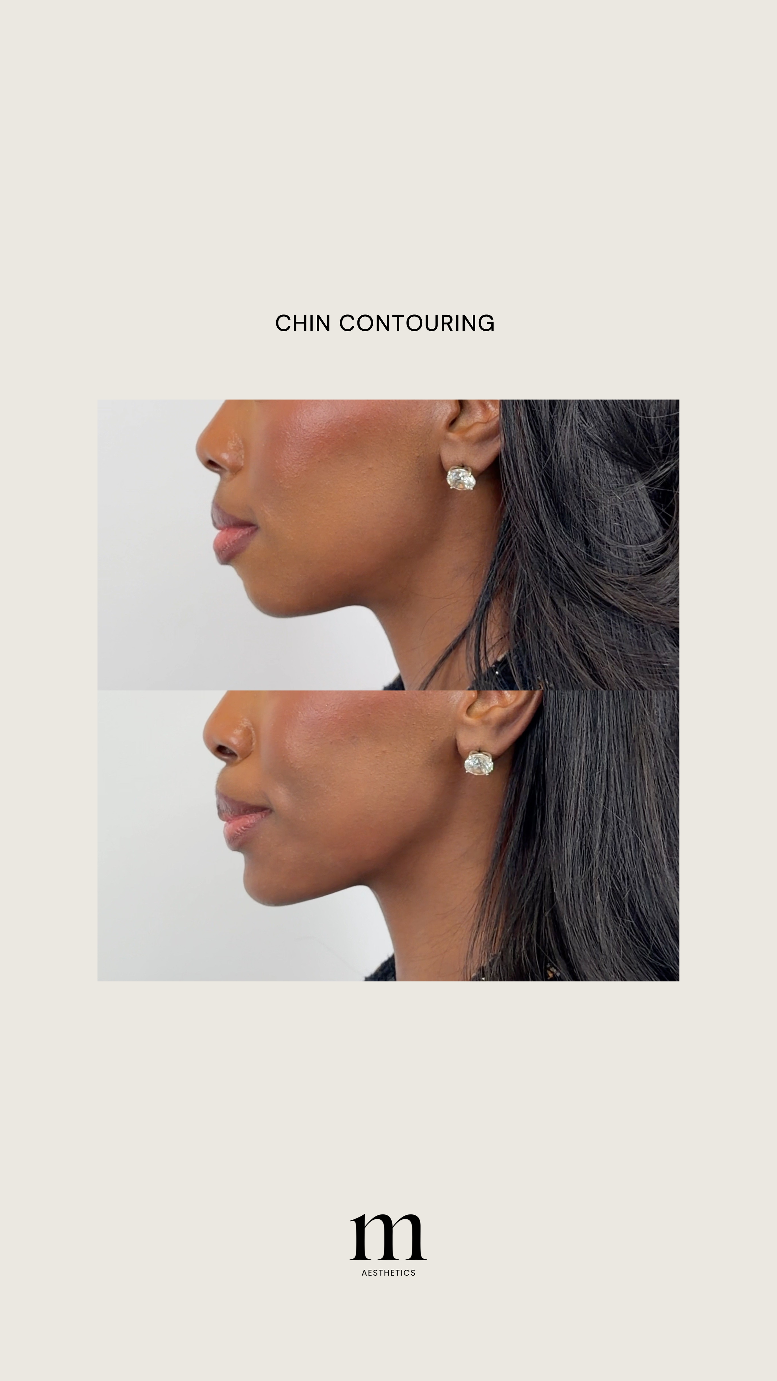 Before and after photos of a woman showcasing chin contouring procedure with the text 'CHIN CONTOURING' and a logo reading 'm AESTHETICS' at the bottom.