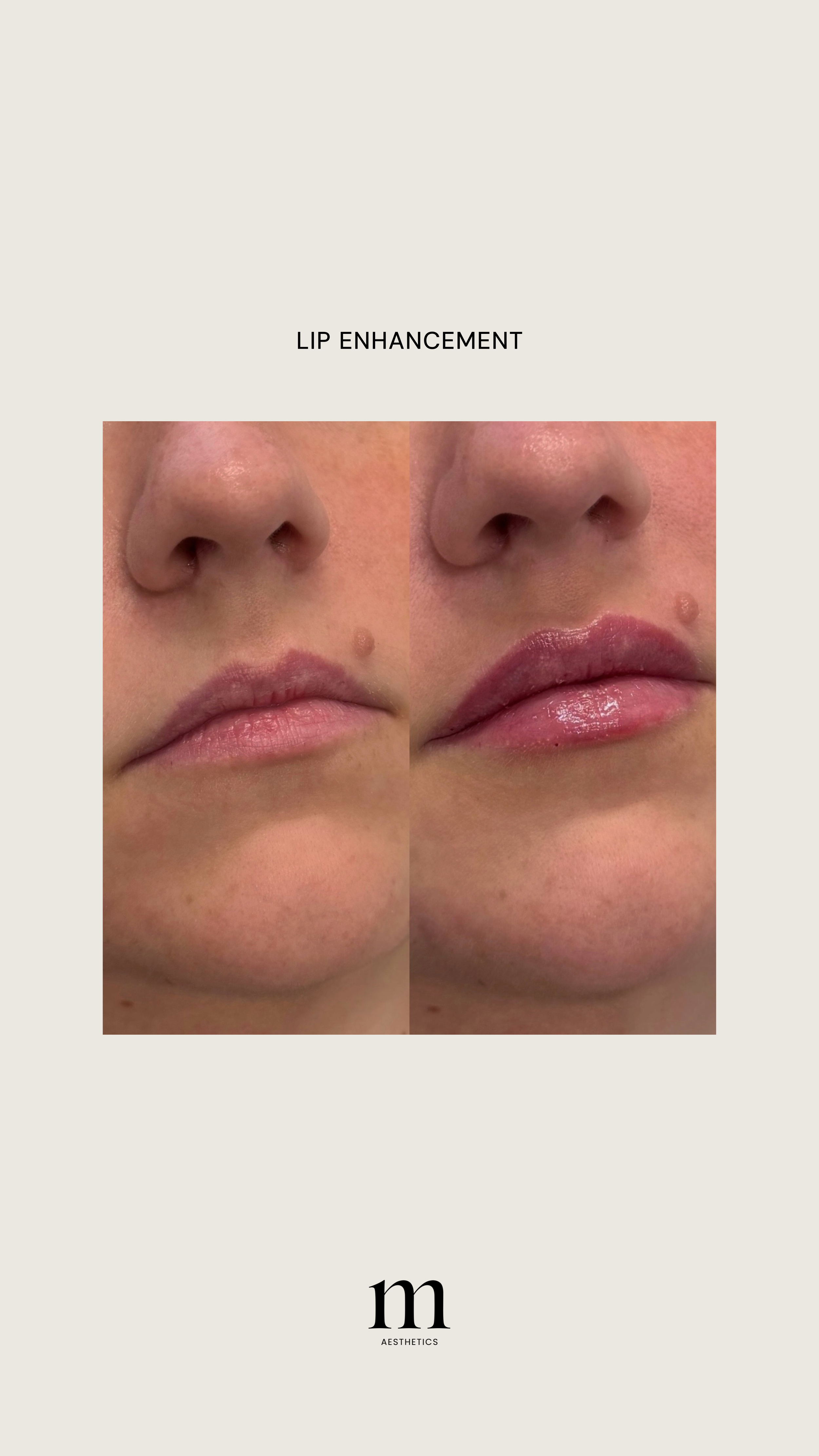 Before and after photos of lips showing lip enhancement procedure, with the right side displaying fuller, more defined lips.