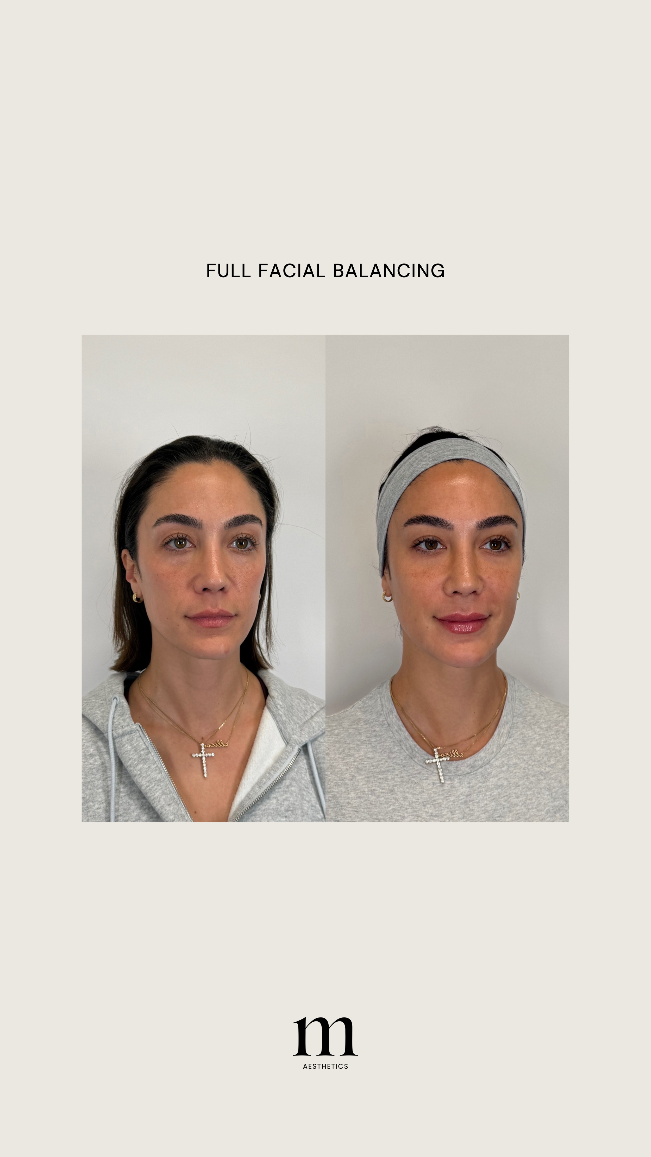 Side-by-side photo of a woman before and after facial balancing treatment, with text "FULL FACIAL BALANCING" above and a logo "m AESTHETICS" below.
