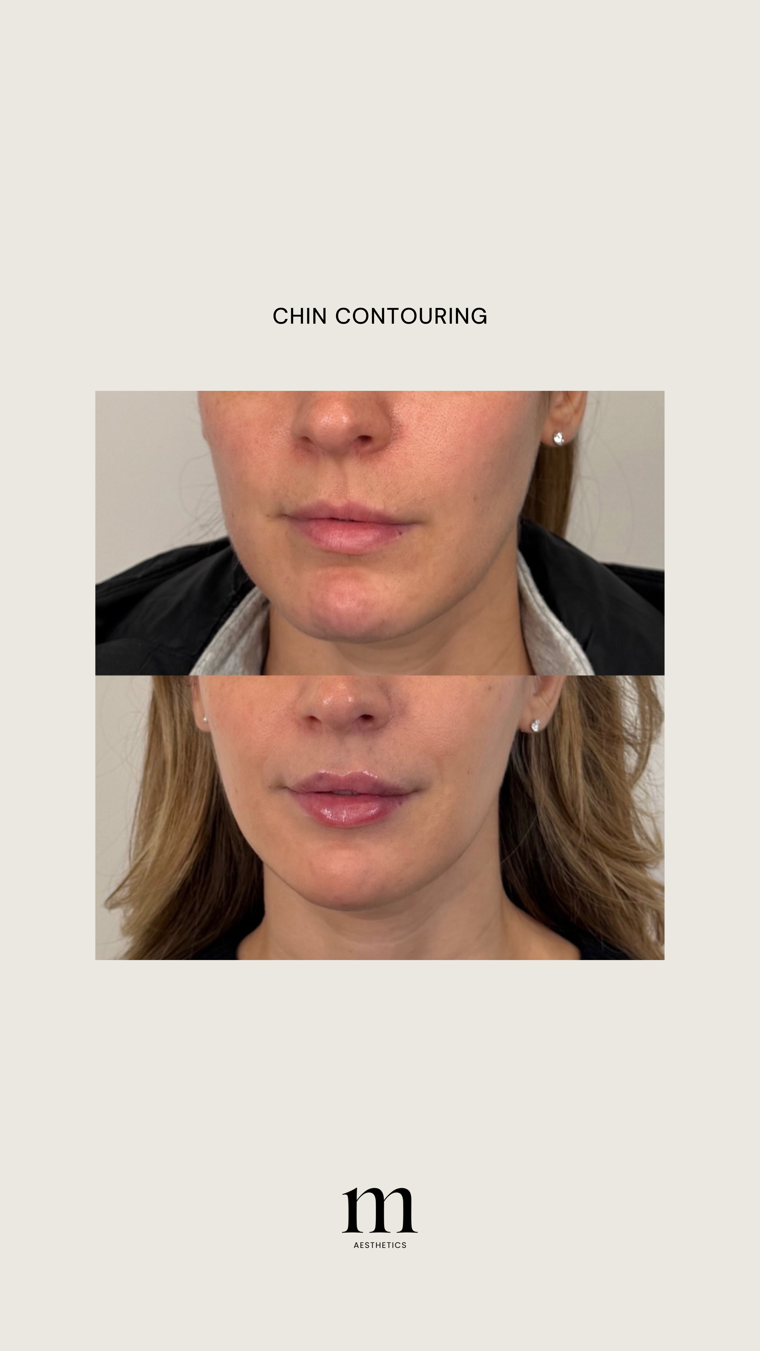 Before and after images showing chin contouring results with the text 'Chin Contouring' and a logo reading 'm AESTHETICS'.