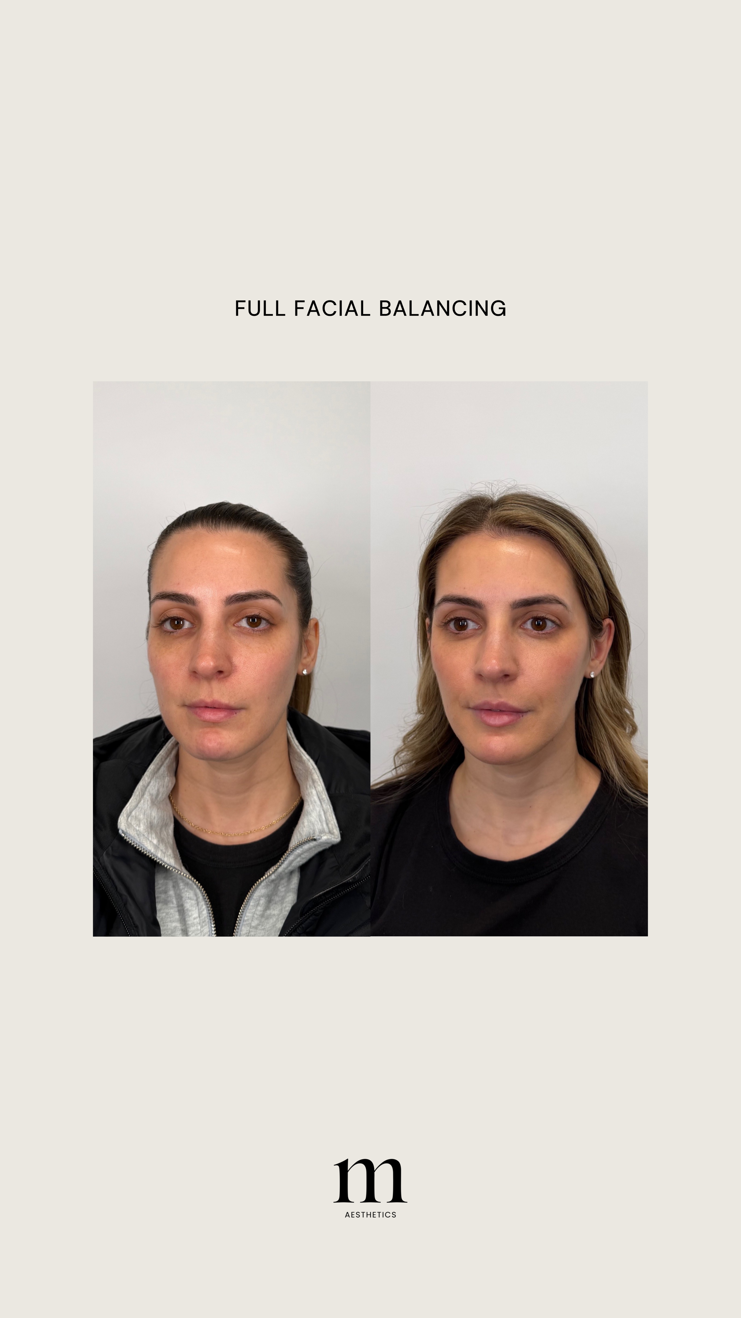 Side-by-side comparison of a woman before and after facial balancing treatment, demonstrating improved facial symmetry and aesthetics.