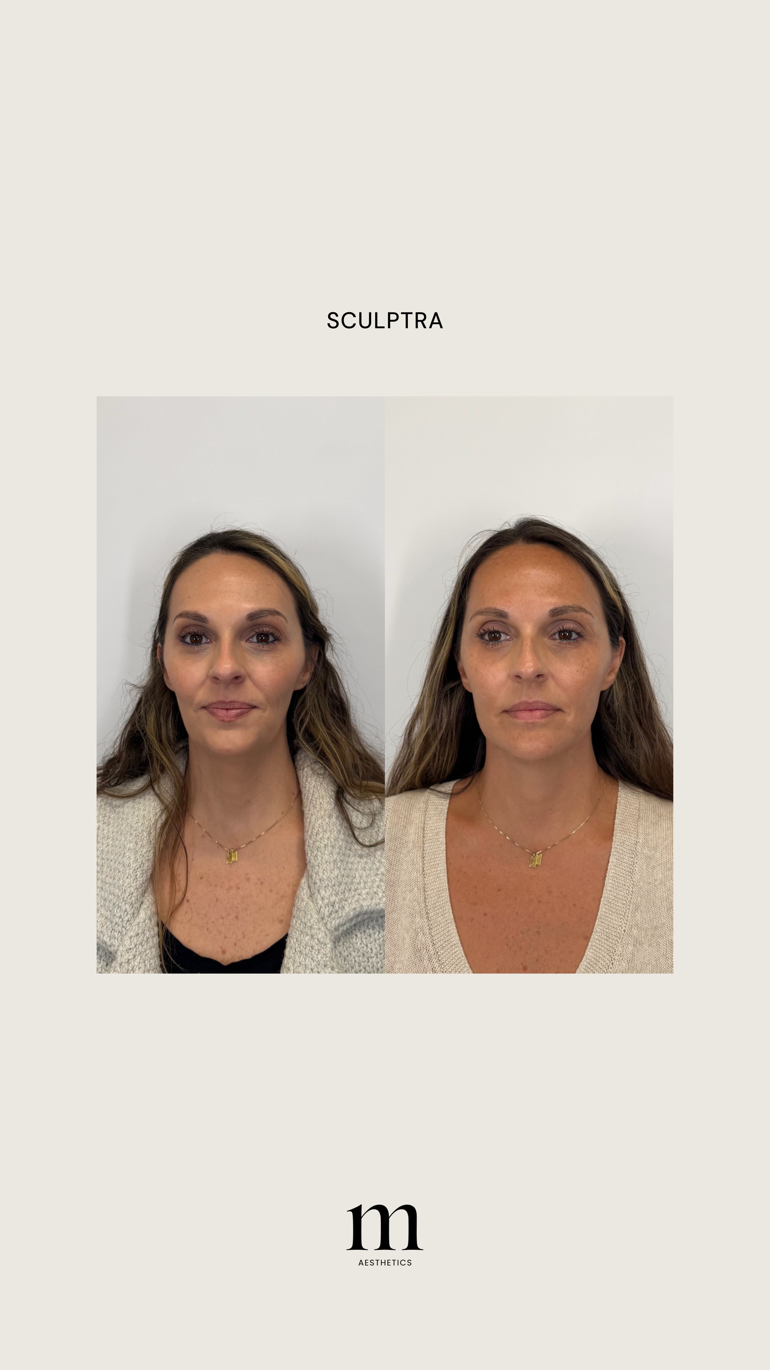 Side-by-side comparison of a woman before and after cosmetic treatment. The woman has light skin, shoulder-length brown hair, wearing a beige sweater and gold necklace. The 'before' photo shows her with freckles and uneven skin tone, while the 'after