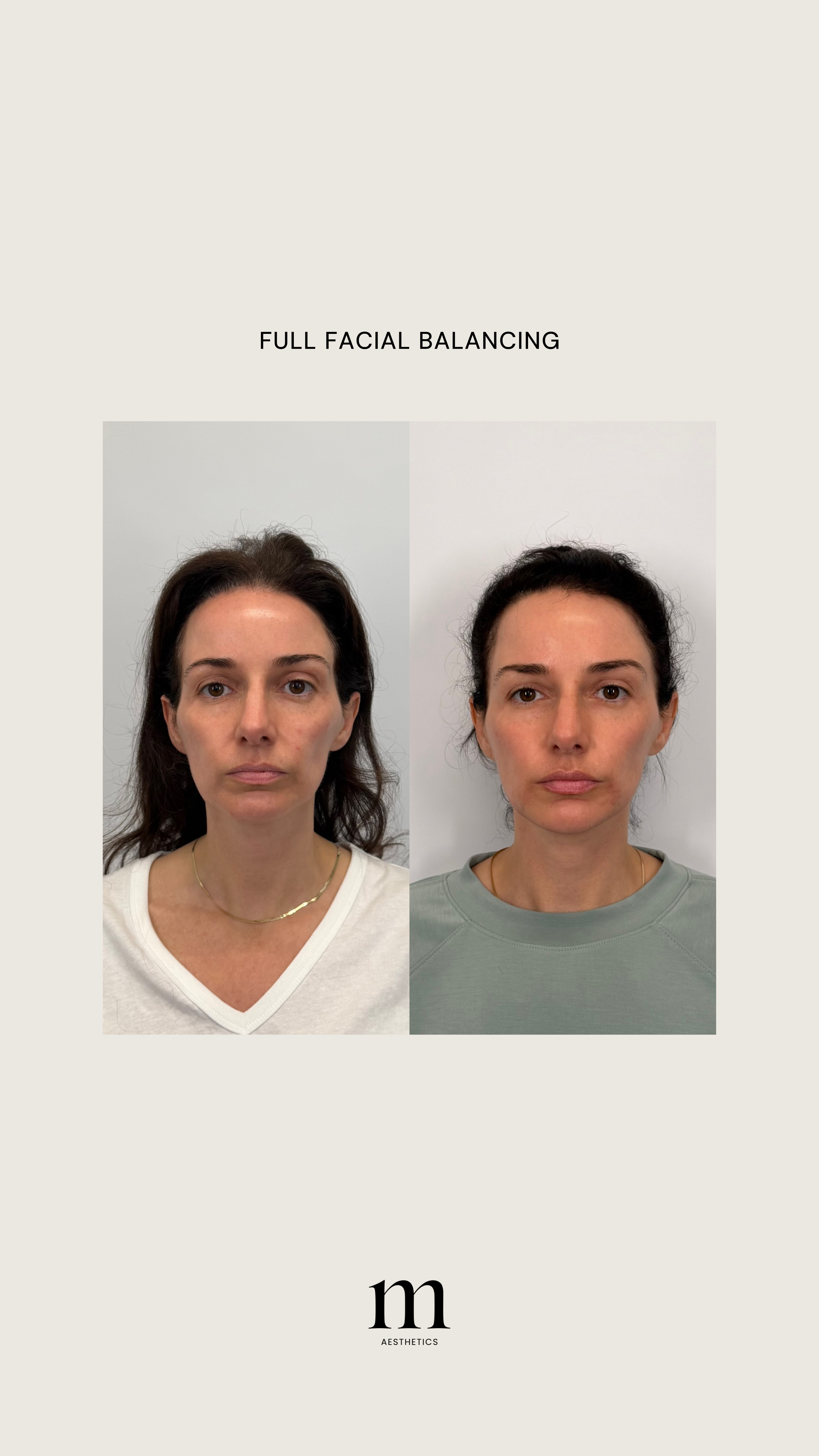 Comparison of two women showing facial changes before and after facial balancing treatment, with the caption 'Full Facial Balancing' and a logo 'm Aesthetics'.