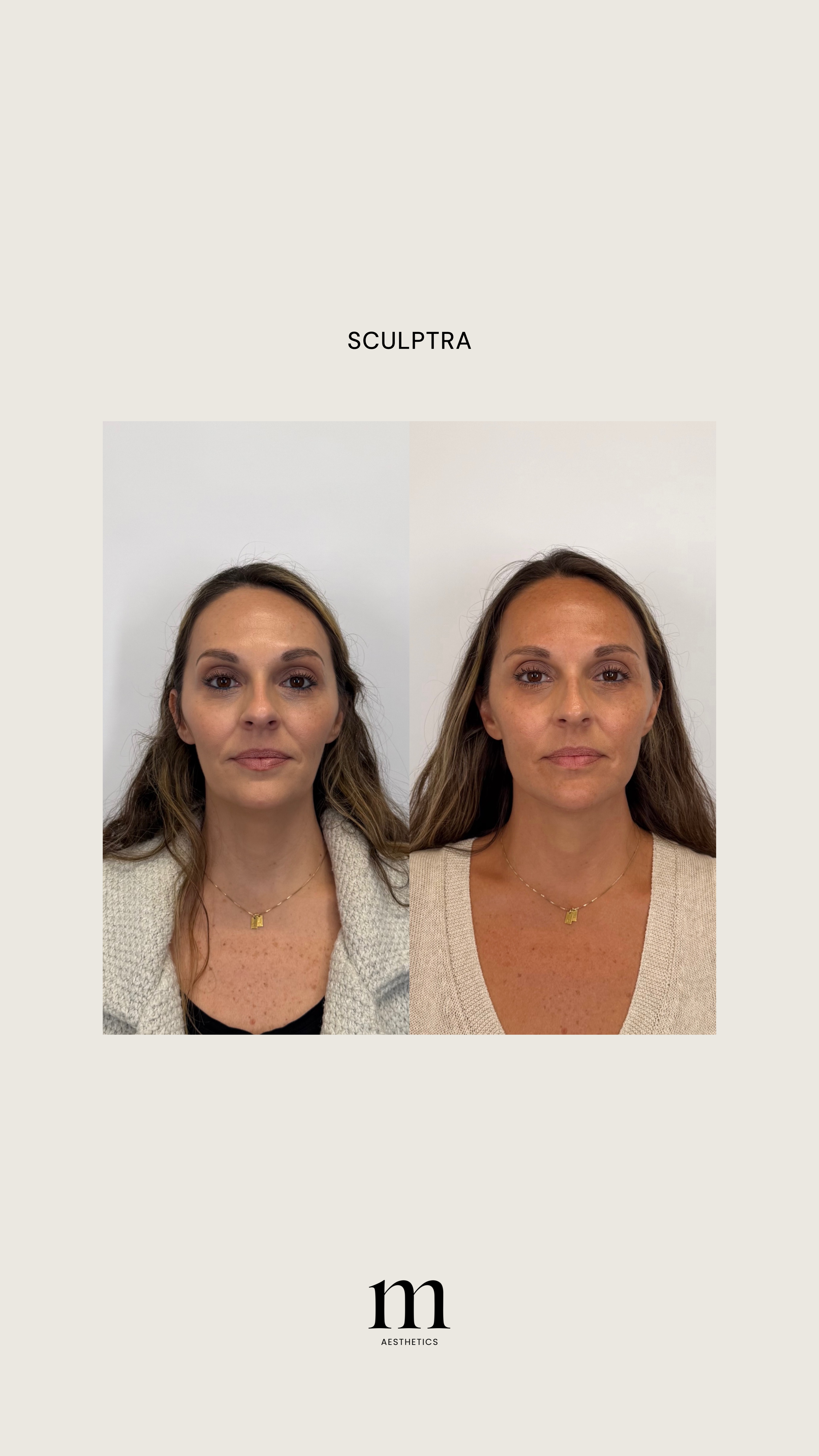Side-by-side comparison of a woman's face before and after aesthetic treatment, with text 'SCULPTRA' at the top and 'm AESTHETICS' at the bottom.