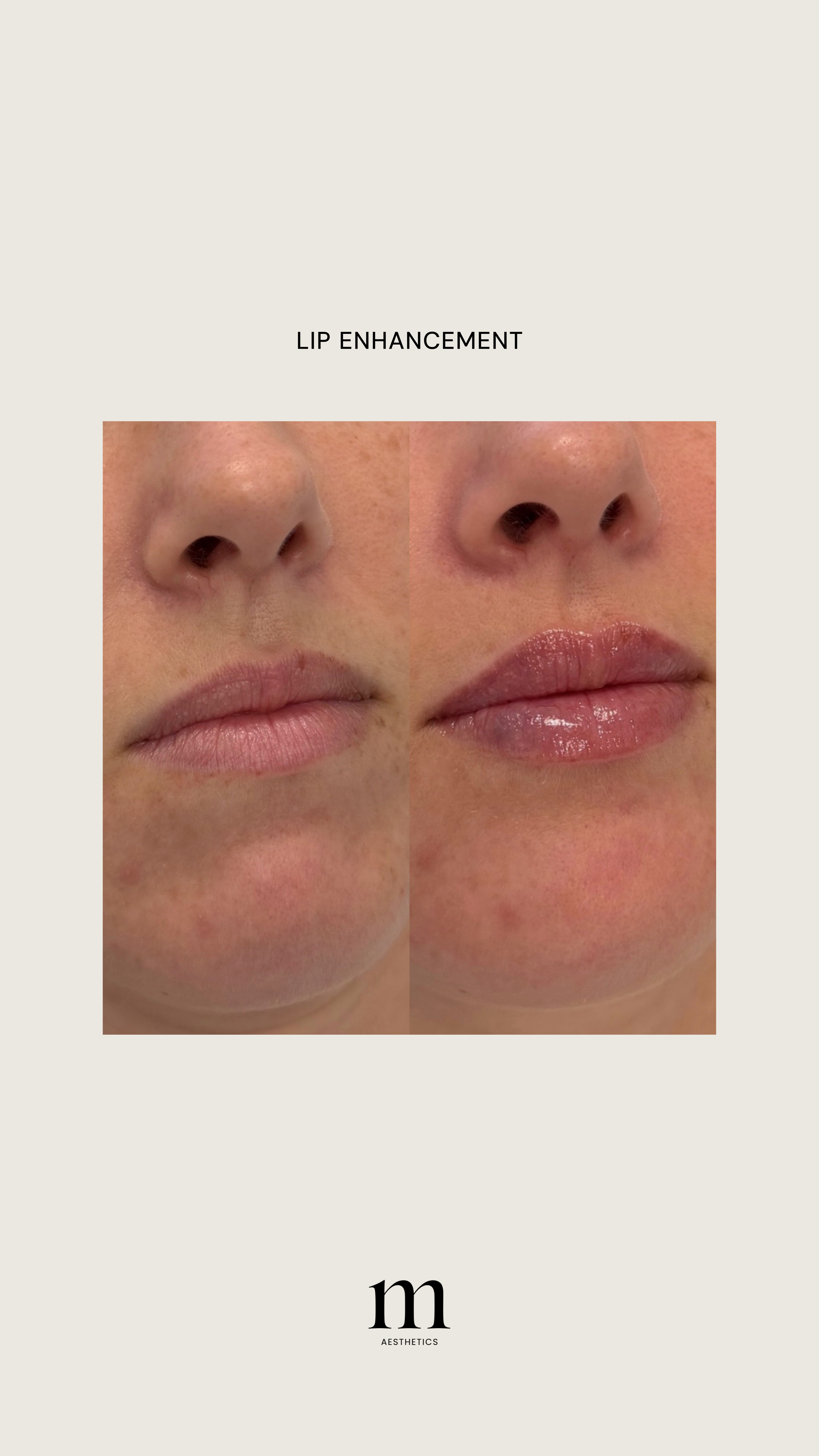 Close-up of a person's lips before and after lip enhancement procedure, with the words "LIP ENHANCEMENT" and an 'm' logo with the word 'AESTHETICS' at the bottom.