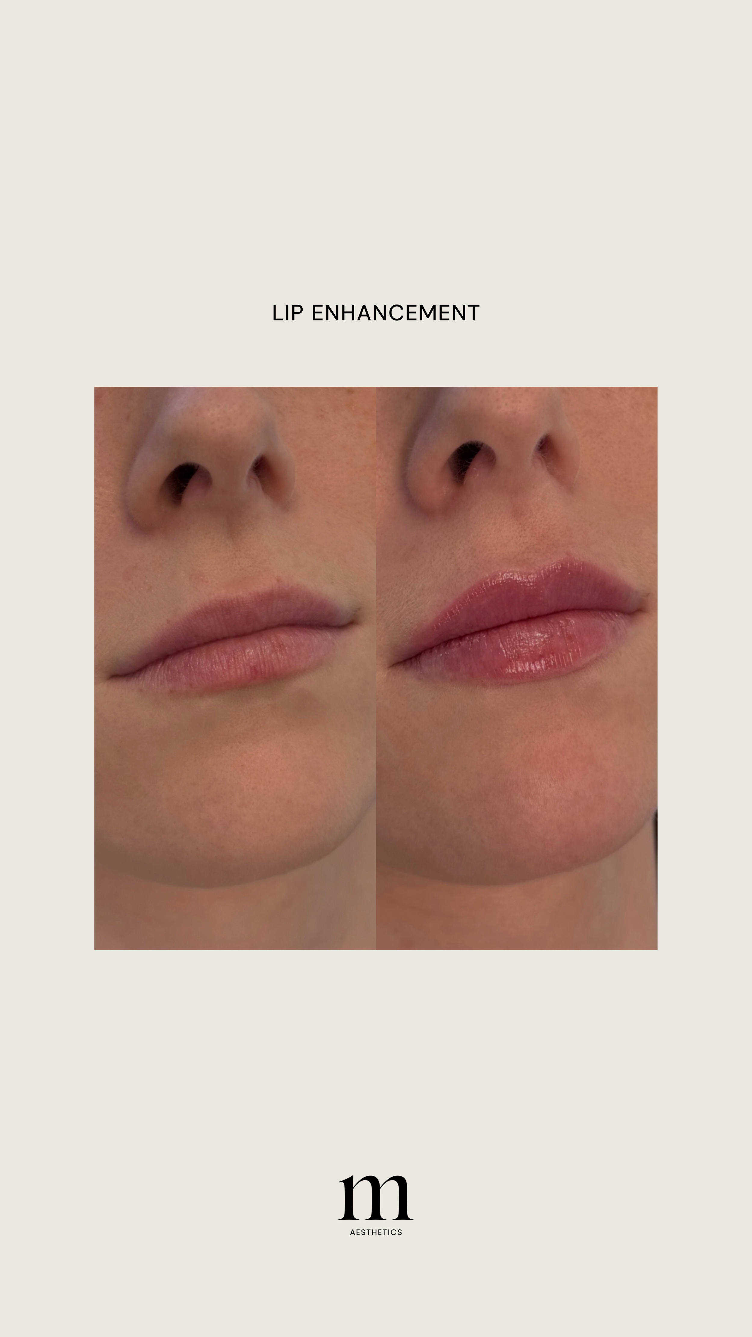 A side-by-side comparison of lips before and after lip enhancement, showing fuller, glossier lips on the right labeled as Lip Enhancement, with branding 'm Aesthetics' at the bottom.