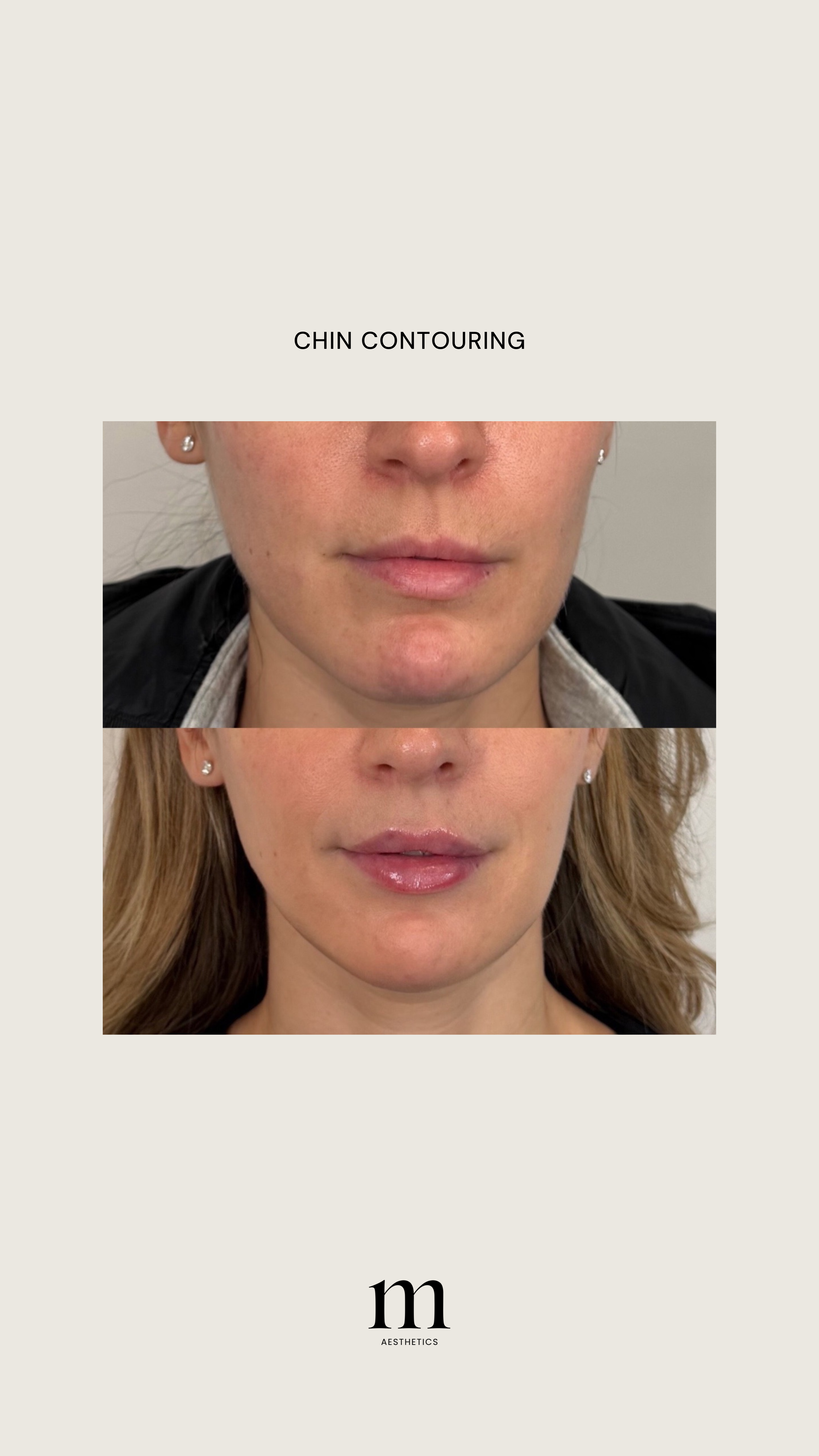 Before and after pictures showing chin contouring results with the words "Chin Contouring" in the center, above a stylized "m" logo and the text "Aesthetics" at the bottom.