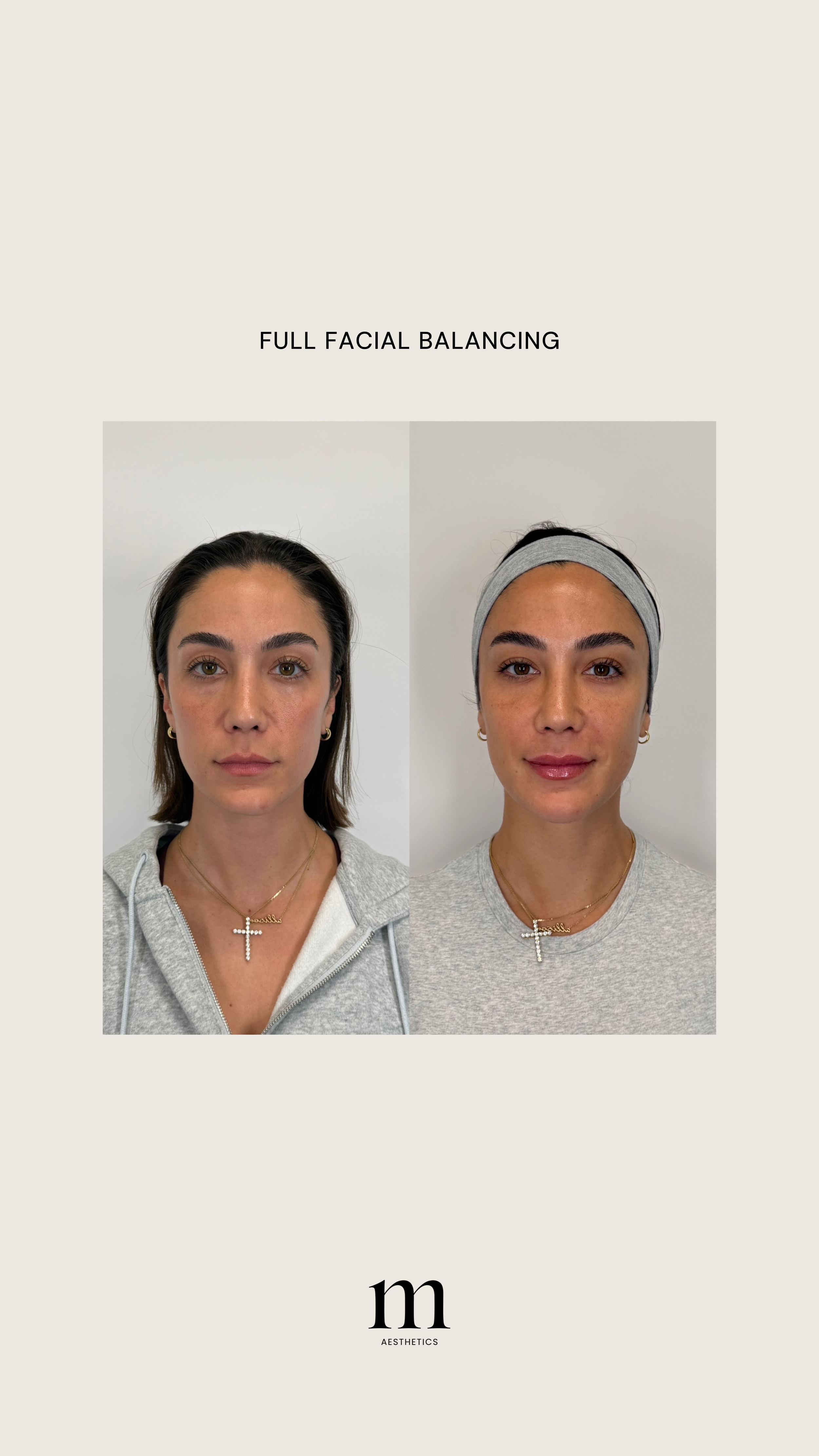 Side-by-side comparison of two women showing before and after facial balancing, with text "FULL FACIAL BALANCING" and a logo "m AESTHETICS".