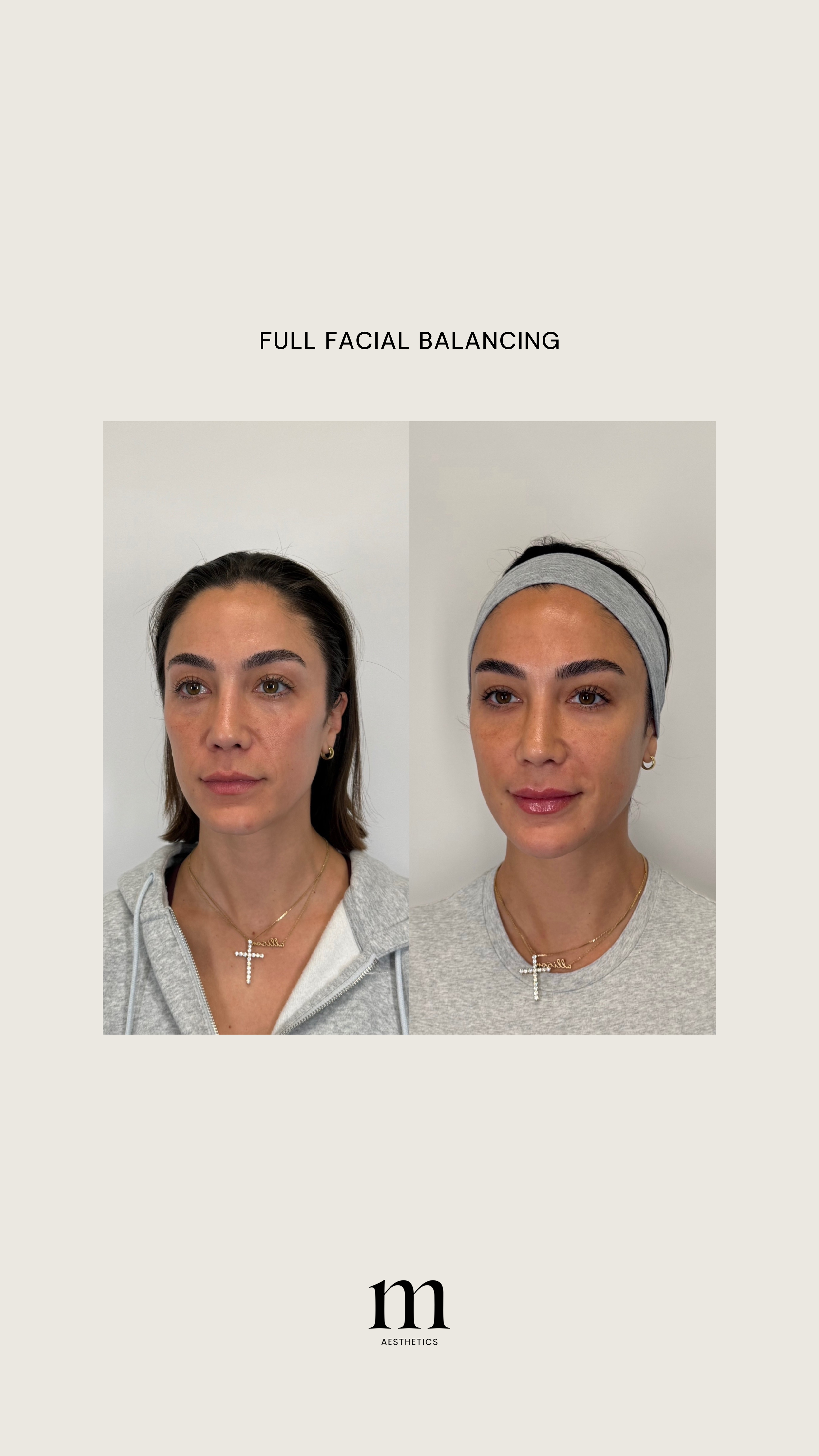 Comparison of woman's face before and after facial balancing treatment, showing improved skin tone and texture.