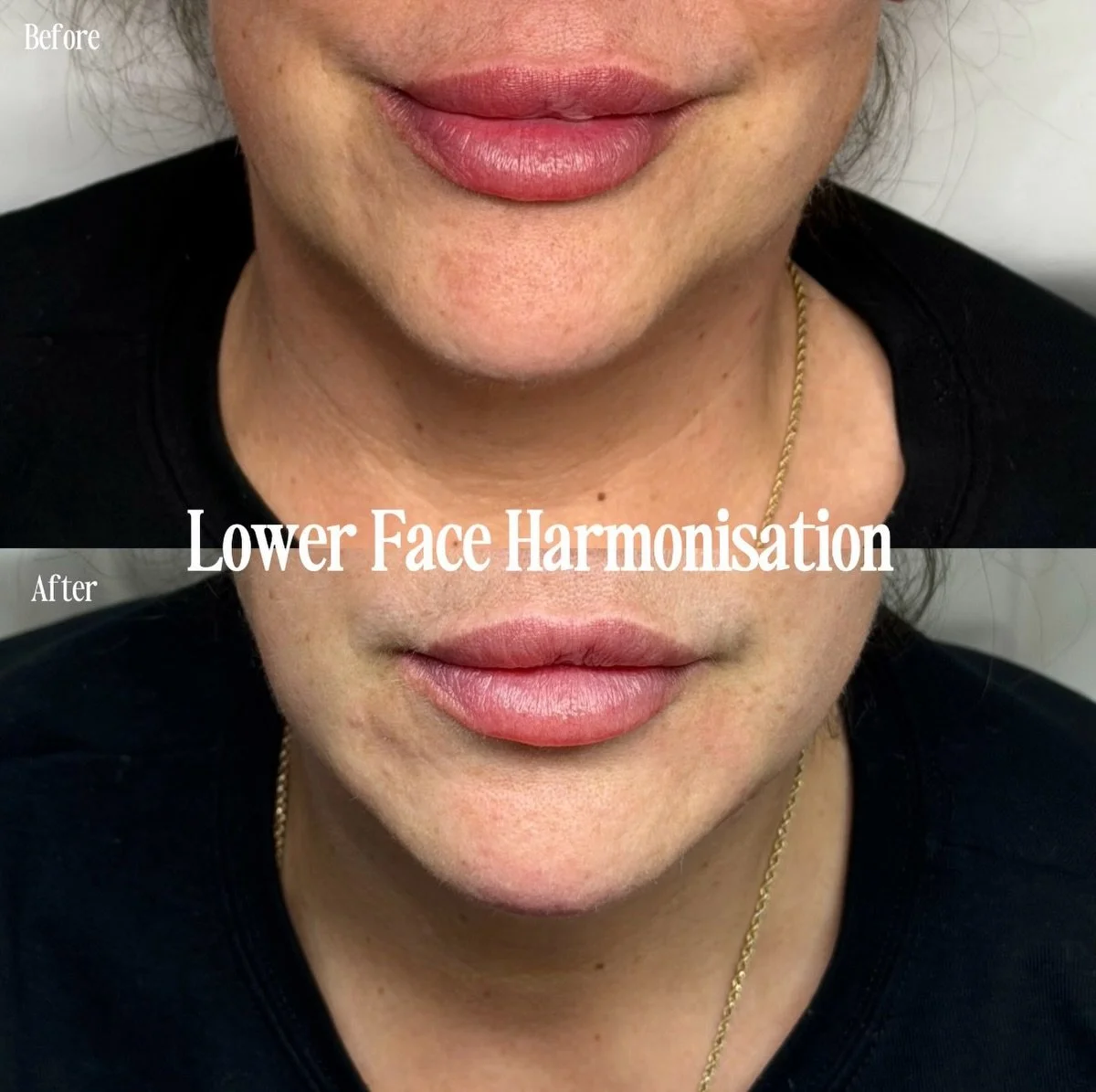 Lower face balance is influenced not only by structure, but also by muscle activity and movement patterns.

This treatment focused on improving asymmetry and creating a softer transition through the lower face for a naturally balanced result.

Facial