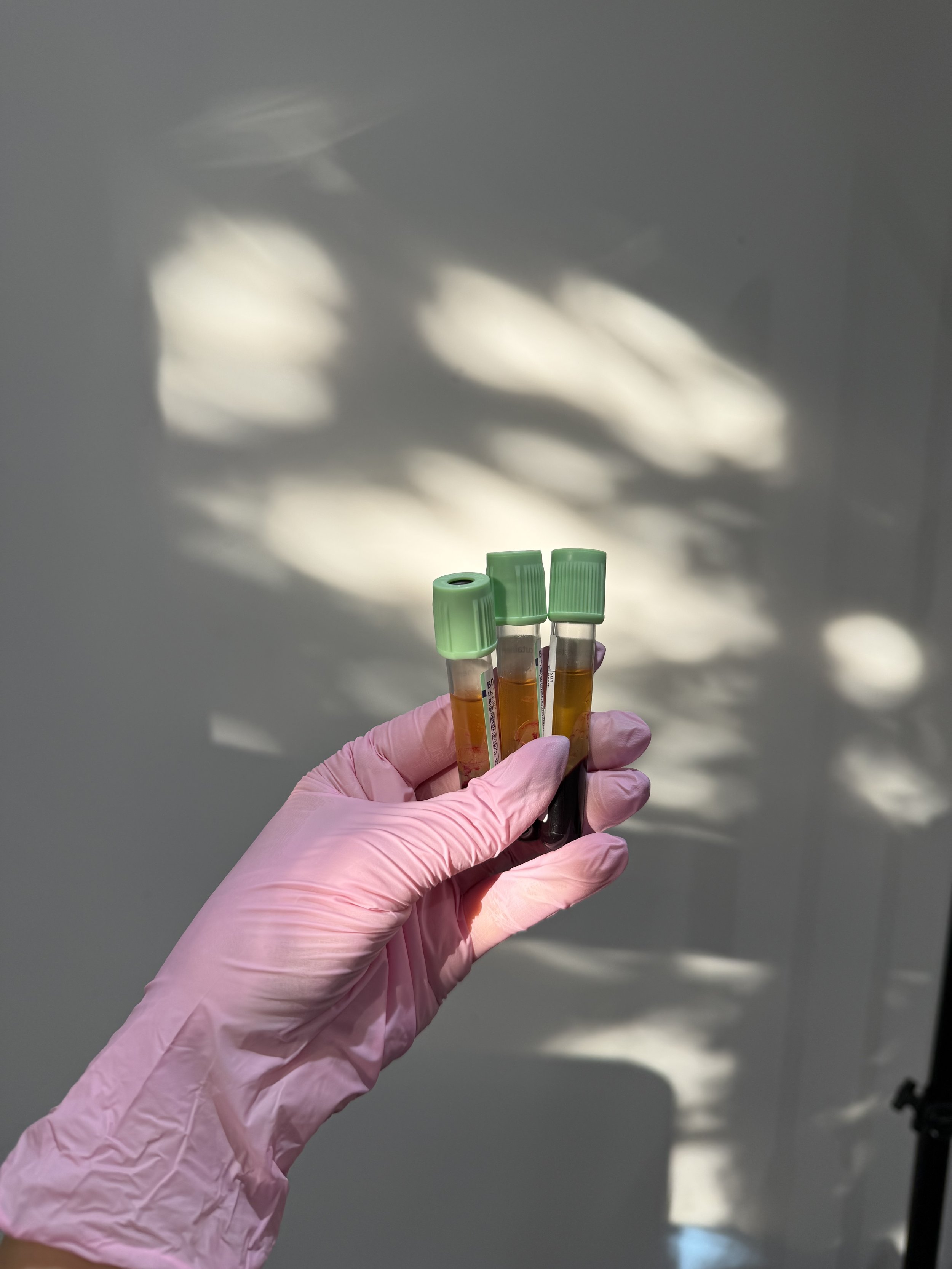 prp hair restoration
