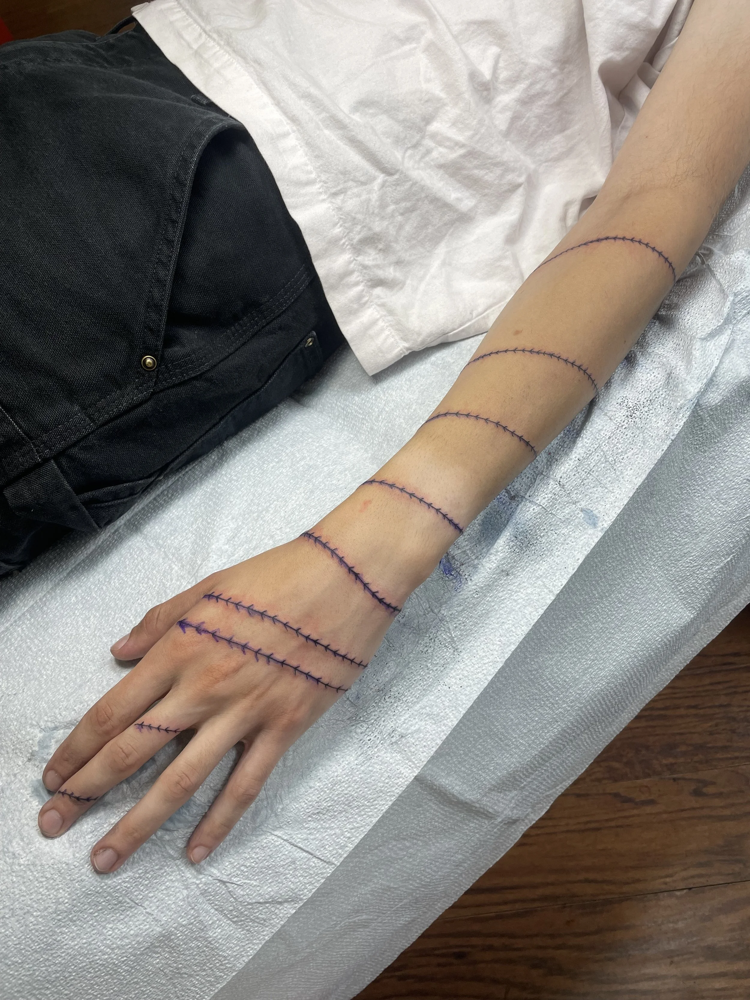 A person's arm lying on a hospital bed with purple marking lines and stitches drawn on it, indicating a medical procedure.