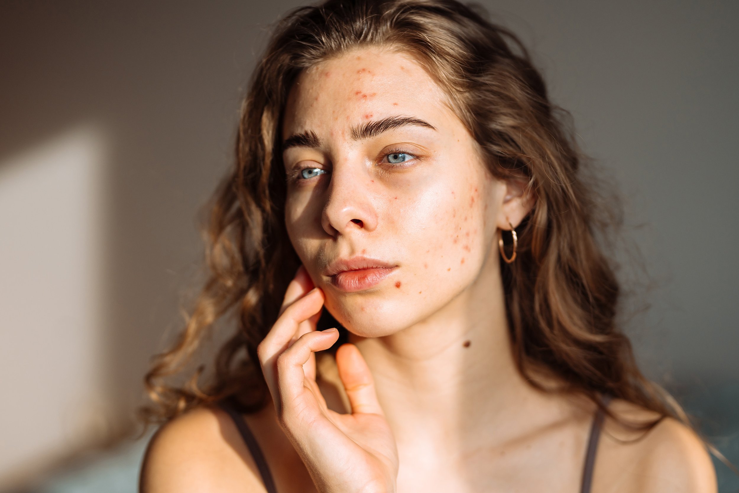 Top Causes of Adult Acne