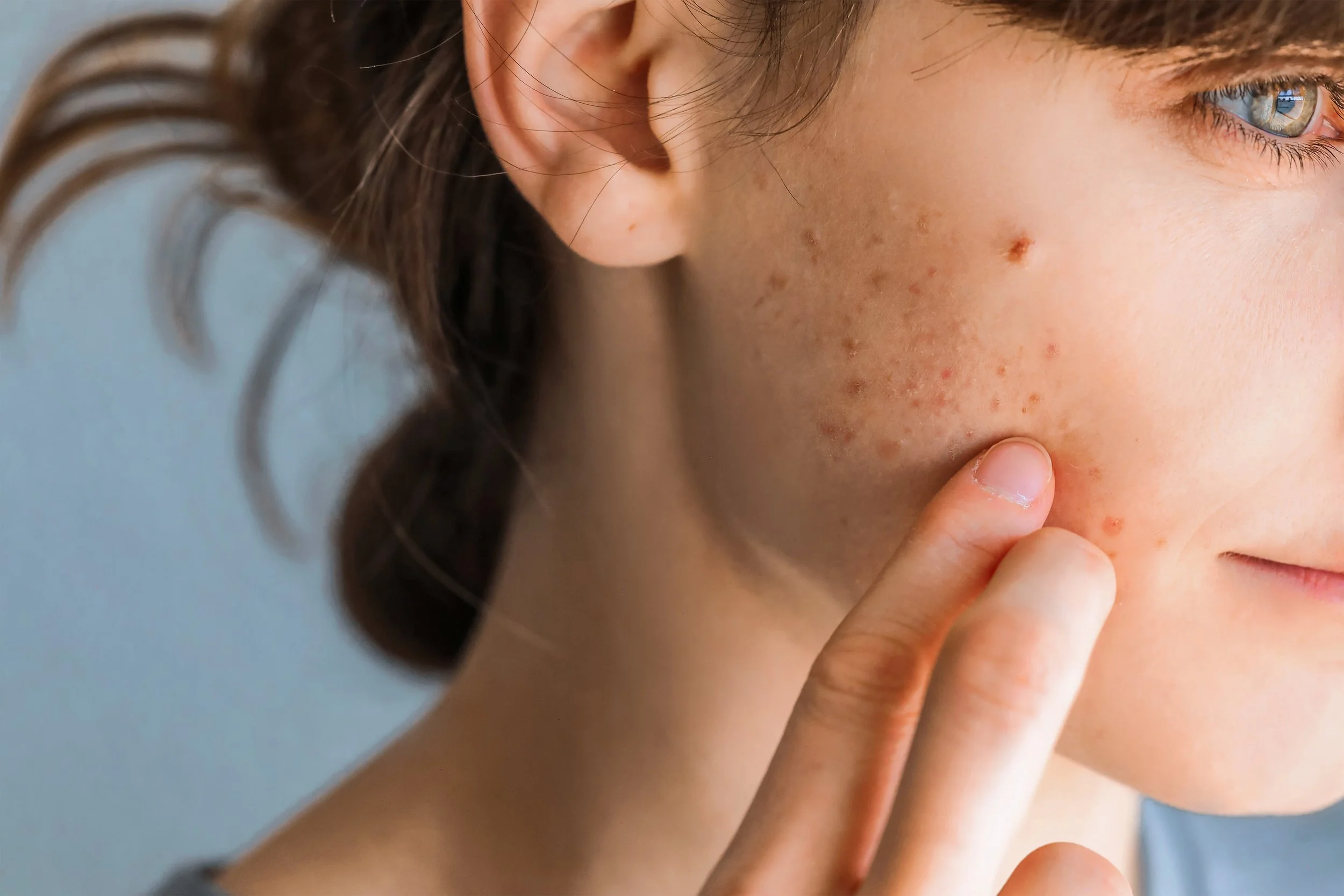 A woman touching her face with her finger, showing skin blemishes and acne