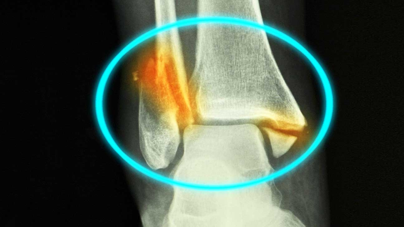 Broken ankle with the fractures highlighted