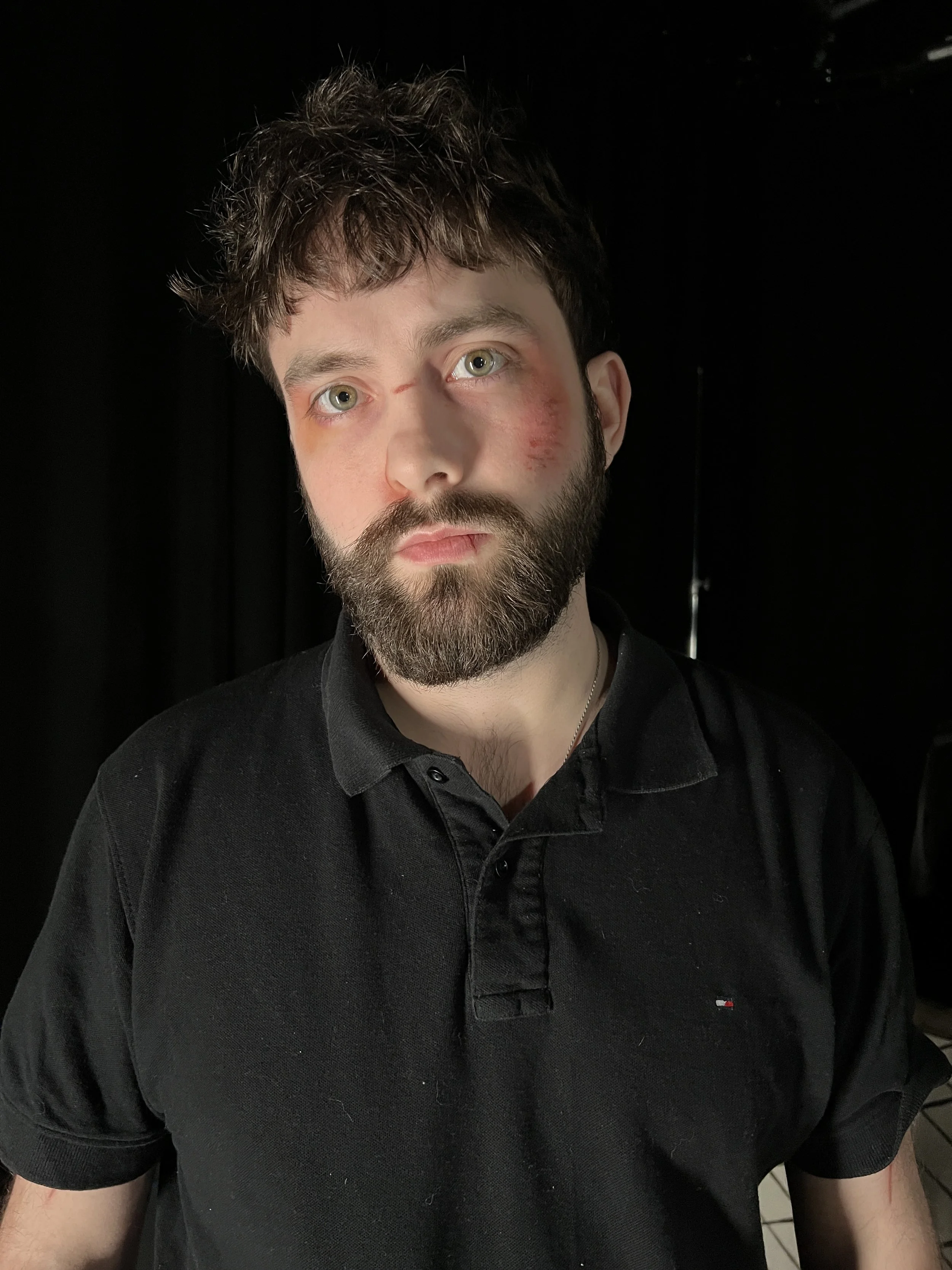 A young man with a beard, brown curly hair, and light green eyes, has bruises and scratches on his face, and is wearing a black polo shirt, standing in front of a dark background.
