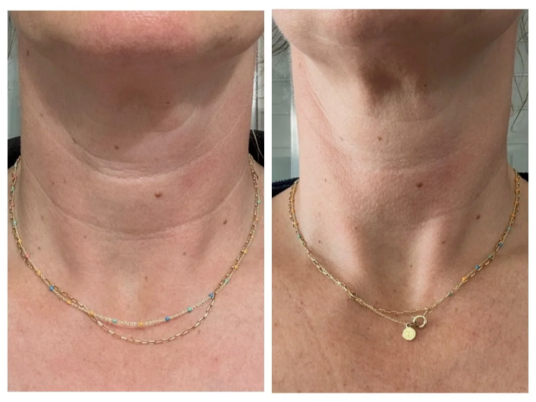 Comparison of a woman's neck and upper chest before and after skin treatment, with jewelry visible in both images.