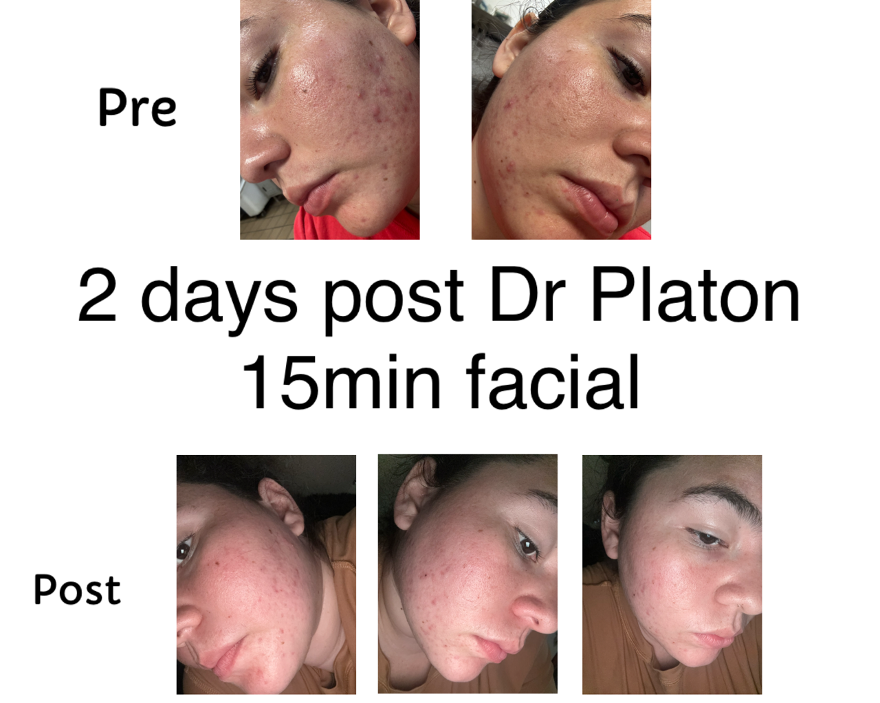 Comparison of a woman's face showing acne before and after a 2-day Dr. Platon facial treatment, with 'Pre' and 'Post' labels and images taken 2 days apart.