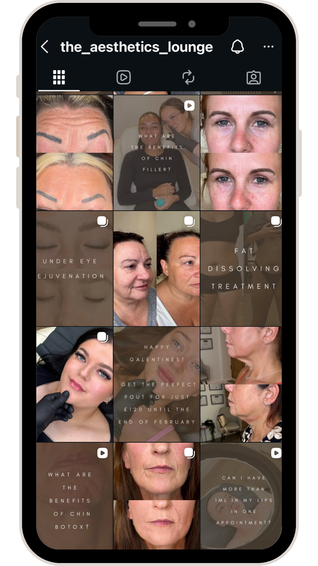 Instagram profile page for 'the_aesthetics_lounge' showing multiple images and videos of women, some with facial treatments, with overlaid text about chin filler, under eye rejuvenation, fat dissolving treatment, and special offers.