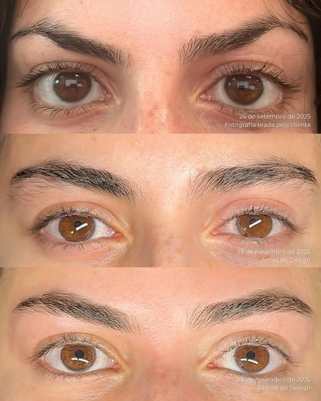 Mais um caso de reconstru&ccedil;&atilde;o de sobrancelhas 🤍

A minha cliente passou muitos anos a tirar o pelo em casa, criando uma cauda super fininha e sobrancelhas assim&eacute;tricas &mdash; uma mais alta do que a outra.

Com um plano de recons