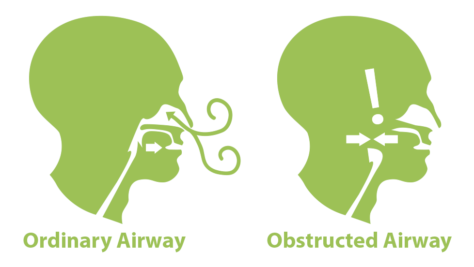 Diagram comparing an ordinary airway to an obstructed airway used to explain sleep apnea at Northwest Ohio Sleep Solutions in Maumee Ohio