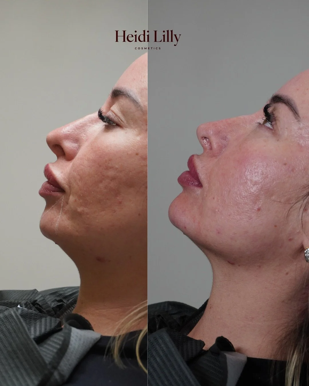 A little chin filler can make a noticeable difference while keeping things natural. 

Before and immediately after 😍

The client will come back for a follow-up, and we&rsquo;ll review together whether they&rsquo;d like a touch more.

By Laura &ndash